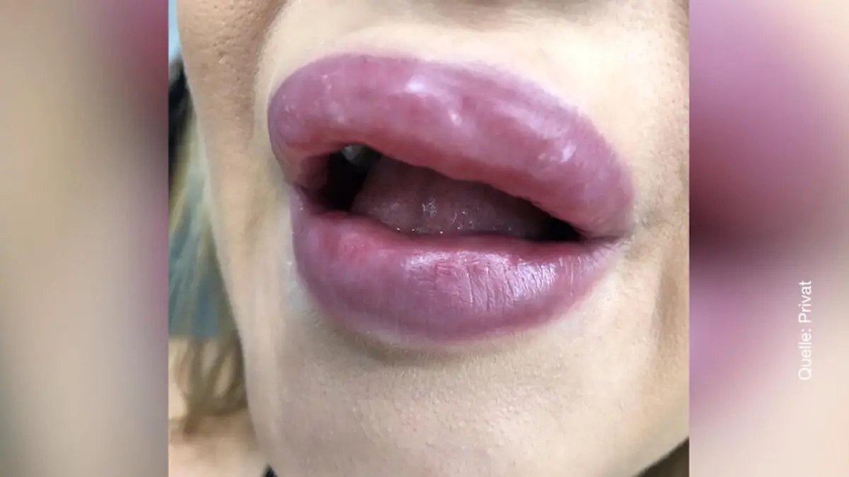 Mehr als zwei Jahre Haft für Duygu Ö. wegen illegal aufgespritzter Lippen