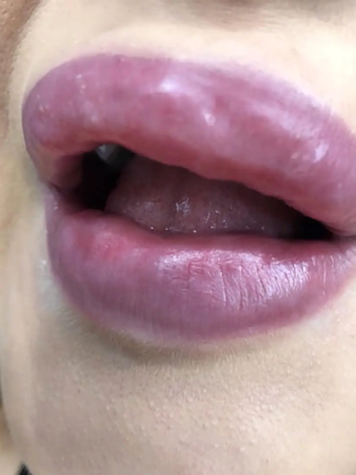 Mehr als zwei Jahre Haft für Duygu Ö. wegen illegal aufgespritzter Lippen