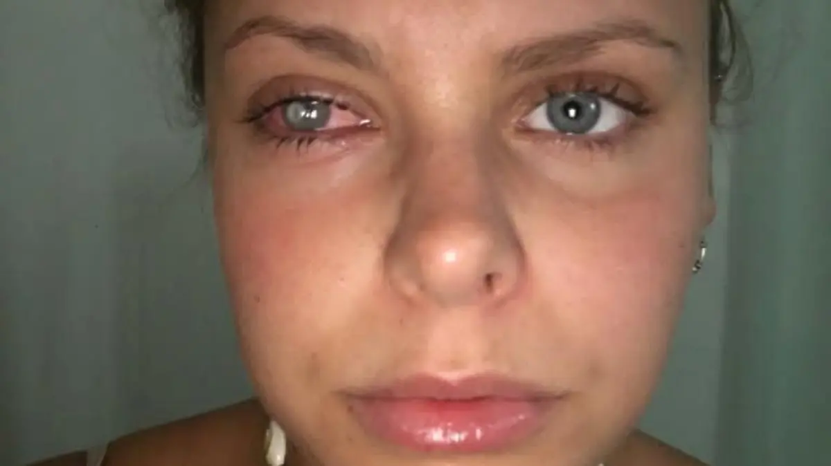 SONDERKONDITIONEN: Satzpreis!
Laura Hawkins suffering from an eye infection. See SWNS story SWSYcontact. A personal trainer was half BLINDED after she got a bacterial infection in her eye - thought to have come from her dirty make up bag. Laura Hawkins, 24, had been travelling across Australia when she woke up one morning in "excruciating pain" and unable to open her right eye. Her contact lenses, which had been kept inside her make up bag, had unknowingly picked up bacteria and infected her eye. It caused a huge ulcer on her cornea that needed immediate medical attention - and could have totally blinded her in one ye if left untreated. / action press