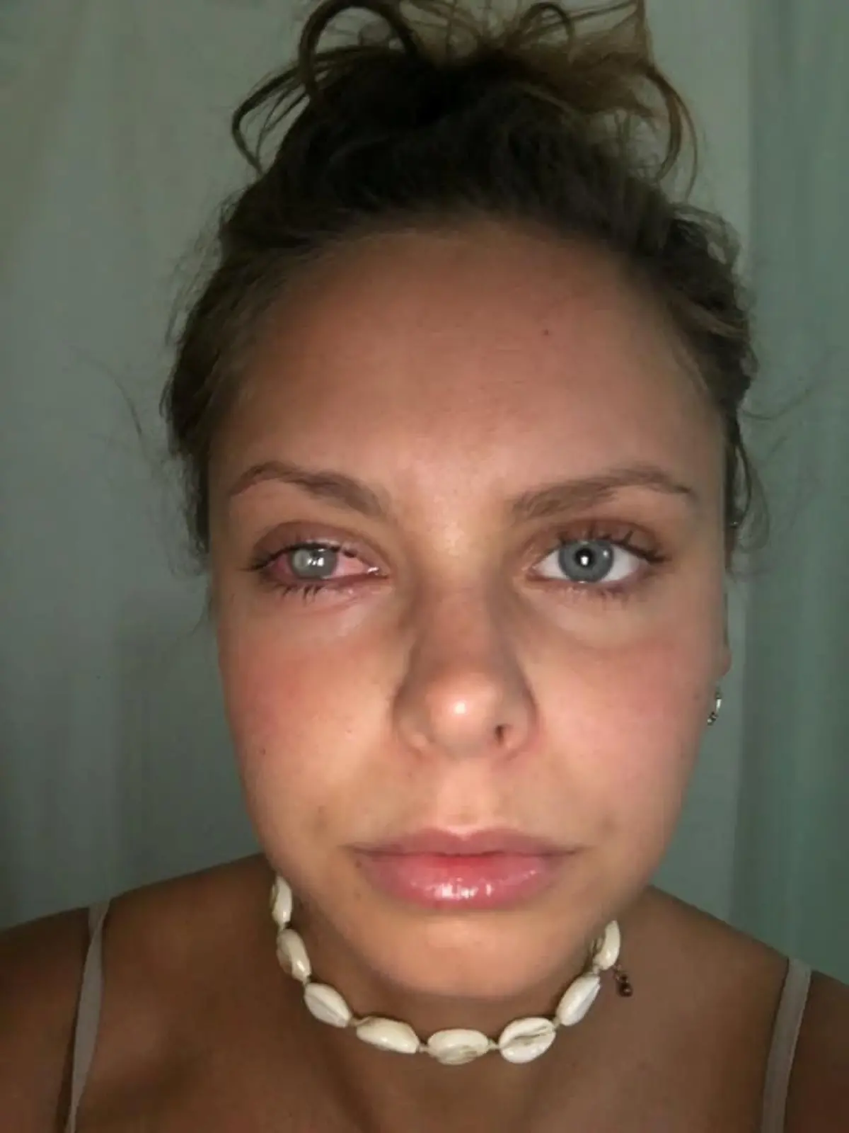 SONDERKONDITIONEN: Satzpreis!
Laura Hawkins suffering from an eye infection. See SWNS story SWSYcontact. A personal trainer was half BLINDED after she got a bacterial infection in her eye - thought to have come from her dirty make up bag. Laura Hawkins, 24, had been travelling across Australia when she woke up one morning in "excruciating pain" and unable to open her right eye. Her contact lenses, which had been kept inside her make up bag, had unknowingly picked up bacteria and infected her eye. It caused a huge ulcer on her cornea that needed immediate medical attention - and could have totally blinded her in one ye if left untreated.  / action press