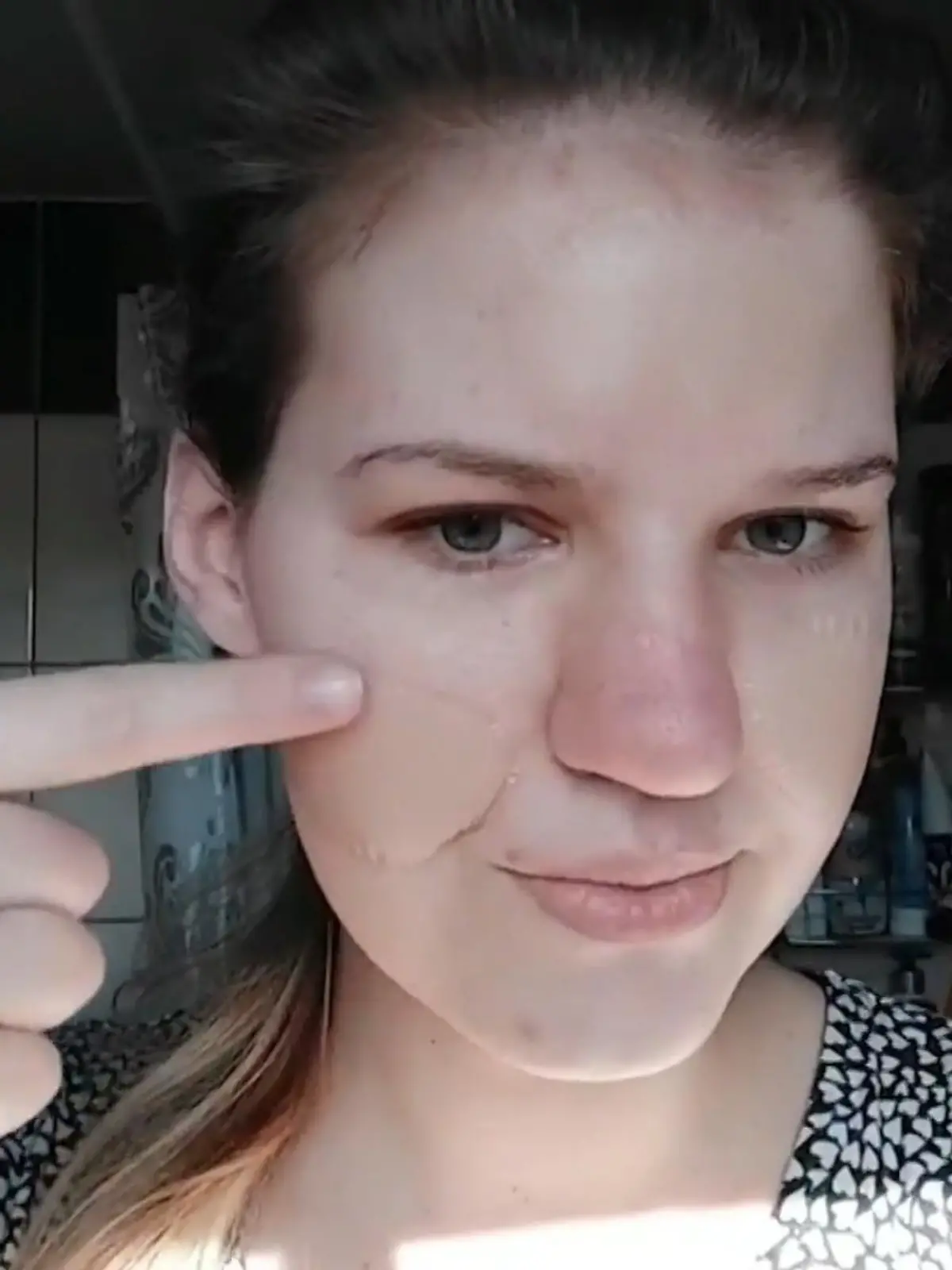 Dieser neue TikTok-Trend soll Pickel verschwinden lassen. Blasenpflaster, die eigentlich für die Füße gedacht sind, sollen helfen.