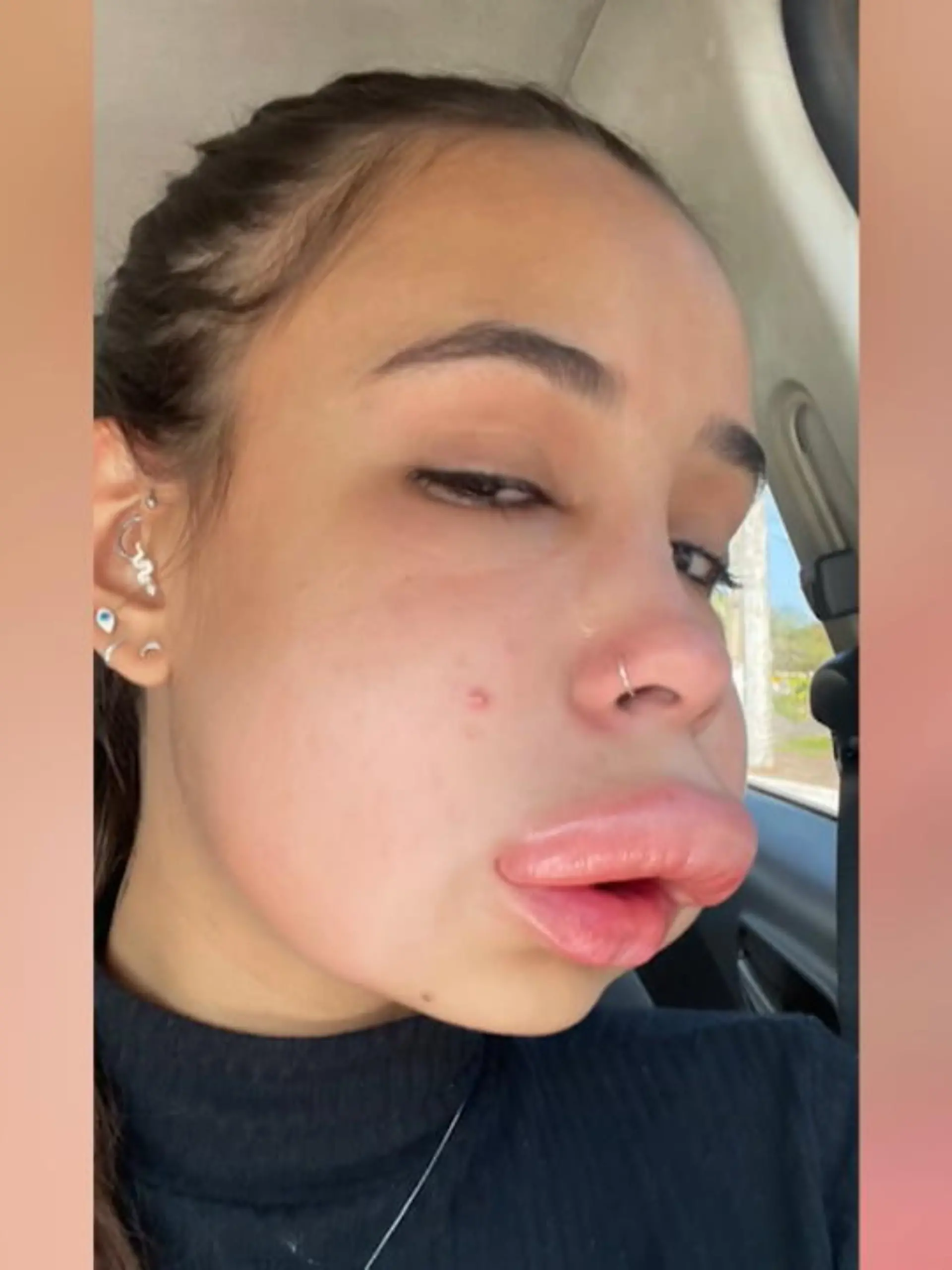Isis aus Brasilien wollte sich nur die Lippen aufspritzen lassen, doch dann schwoll ihr ganzes Gesicht an. Wie es dazu kam und wie es ihr jetzt geht, erfahren Sie im Video.