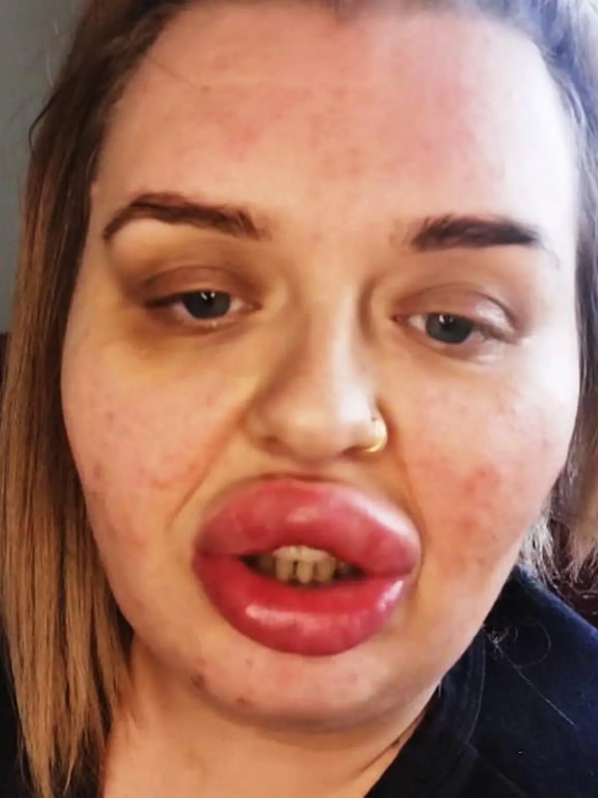 So hatte sich Lauren Evans ihre Lippenbehandlung nicht vorgestellt: Kaum ist das Hyaluron drin, schwellen ihre Lippen an, sie hat eine allergische Reaktion.