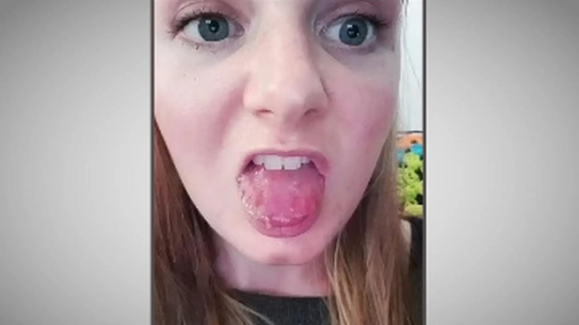 Caitlin Alsop hatte eine angeschwollene Zunge.