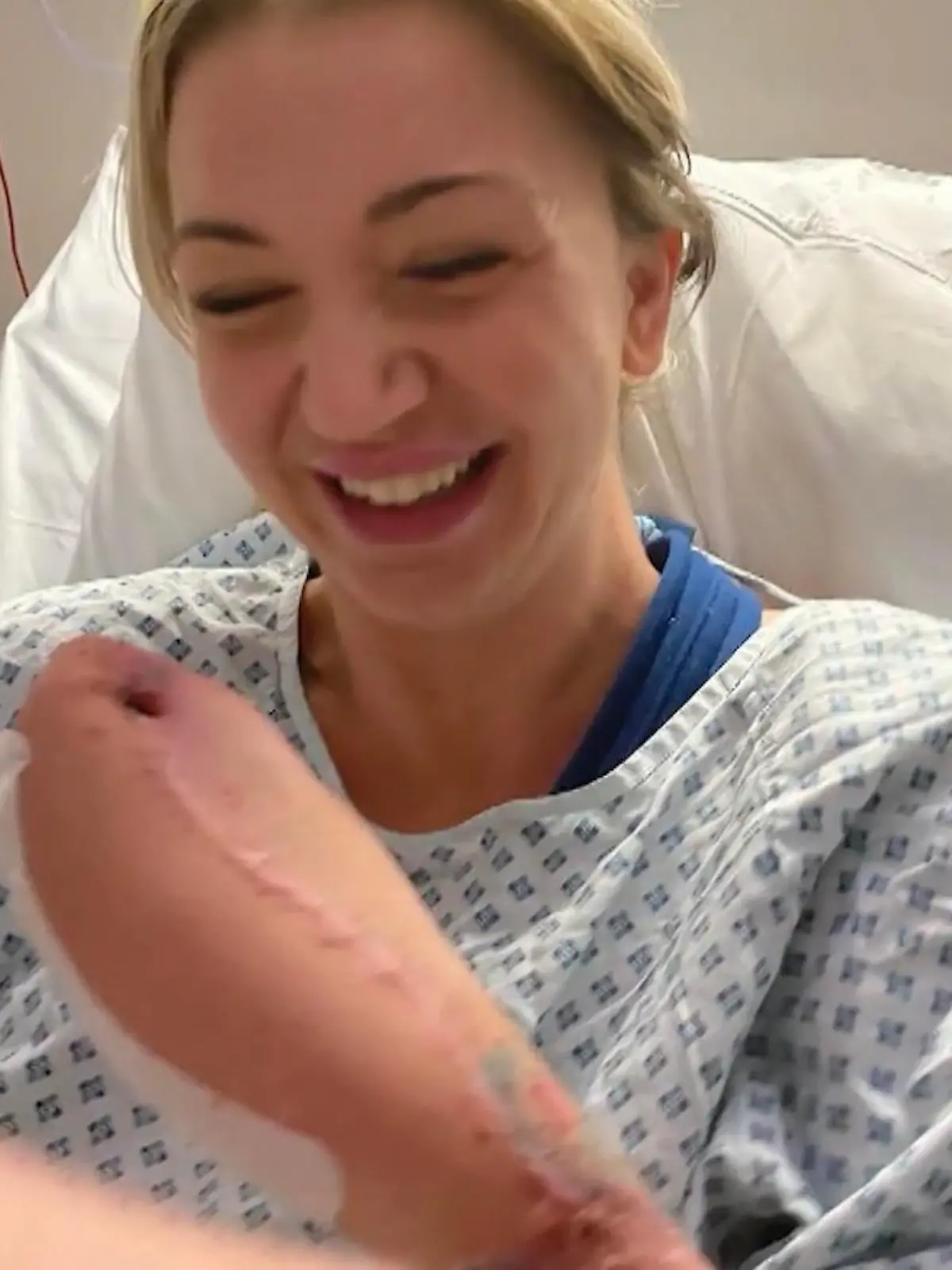 Als Frau mit der Haifischhand macht Sadie Kemp im Frühjahr dieses Jahres weltweit Schlagzeilen. Nach einer Blutvergiftung konnten Ärzte ihre Hand nicht retten. Doch Sadie lässt sich ihren Humor und ihre Lebensfreude nicht nehmen. Doch jetzt, wenige Monate später, die Horror-Nachricht: Auch ihre Unterschenkel müssen amputiert werden. Für Sadie ein herber Schlag, doch für sie ist das wichtigste, sich nicht unterkriegen zu lassen. Wir haben sie besucht und mit ihrer über ihr Schicksal gesprochen. Wie sie es schafft trotz ihres harten Schicksals so herrlich humorvoll zu bleiben, erzählt sie im Video.