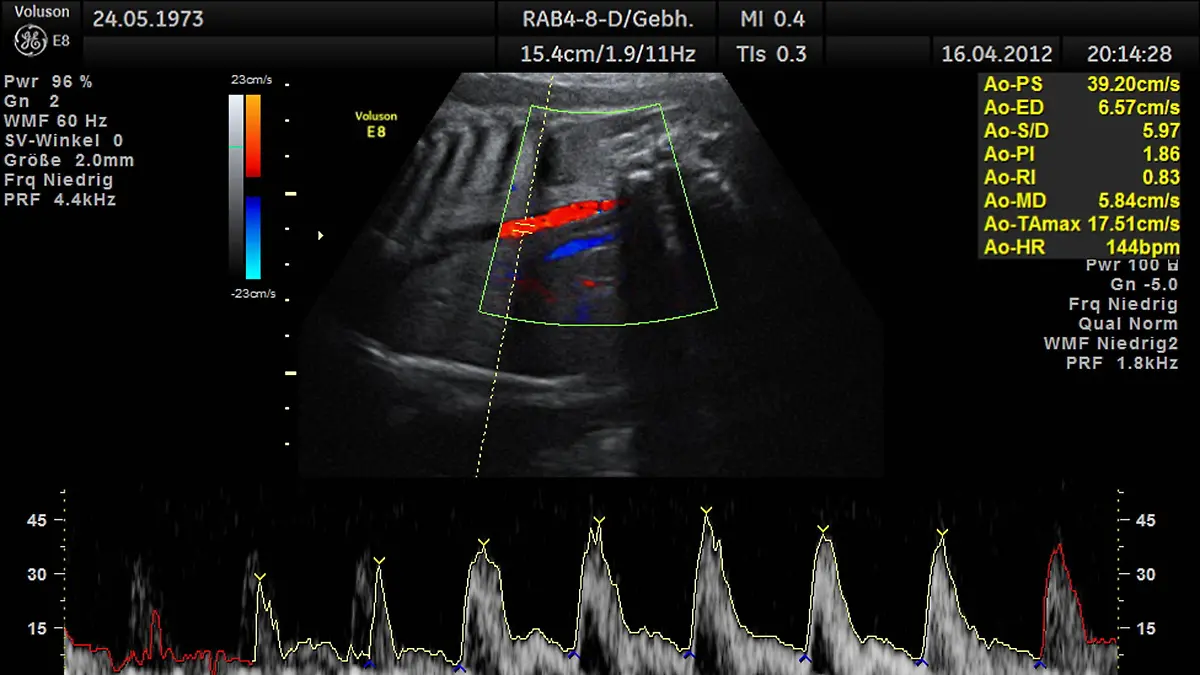 Ultraschallaufnahme eines Embryos im Mutterleib mit Herztondiagramm | sonogram of an embryo in the womb with heart tone diagram