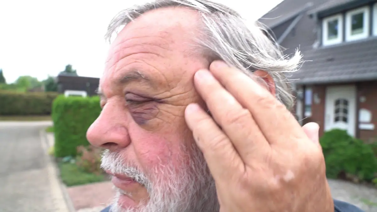 Werner I. zeigt uns das blaue Auge, das ihm der Professor zugefügt haben soll.
