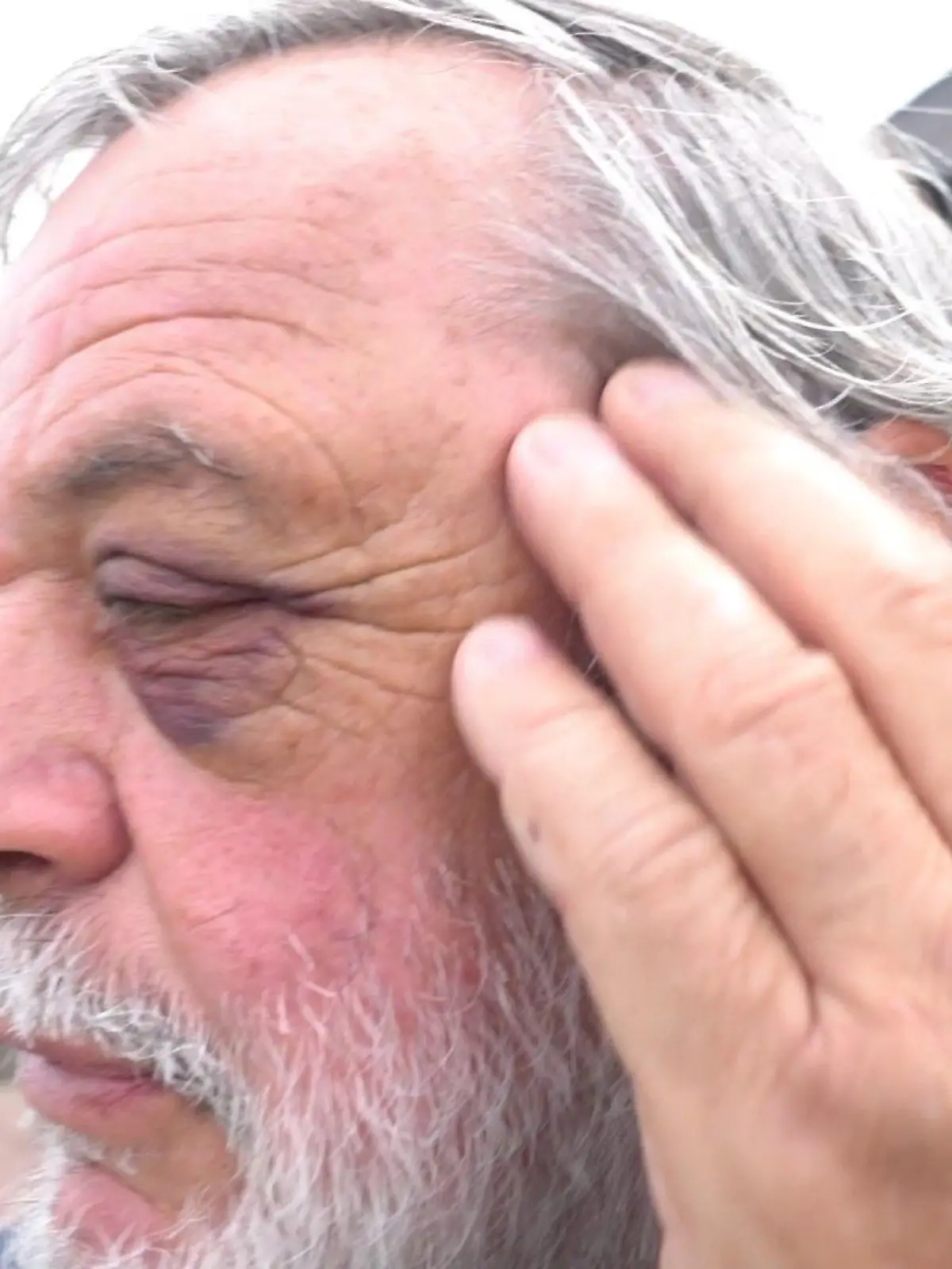 Werner I. zeigt uns das blaue Auge, das ihm der Professor zugefügt haben soll.