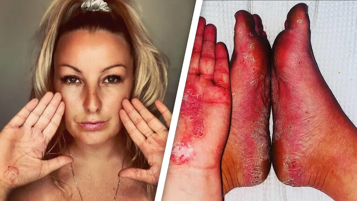 Die Australierin Nicole Preece zeigt ihre mit Ausschlägen übersäten Hände und Füße