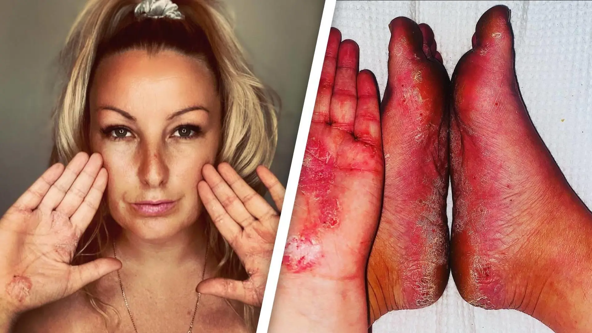 Die Australierin Nicole Preece zeigt ihre mit Ausschlägen übersäten Hände und Füße