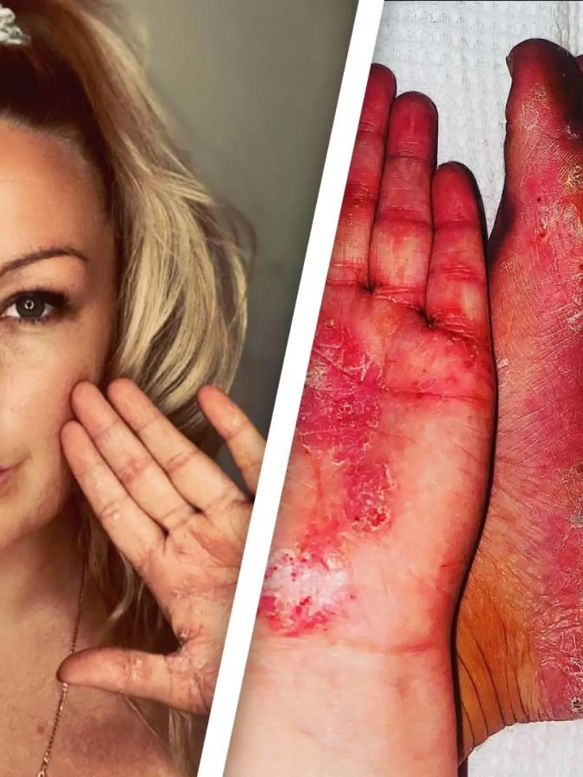 Die Australierin Nicole Preece zeigt ihre mit Ausschlägen übersäten Hände und Füße