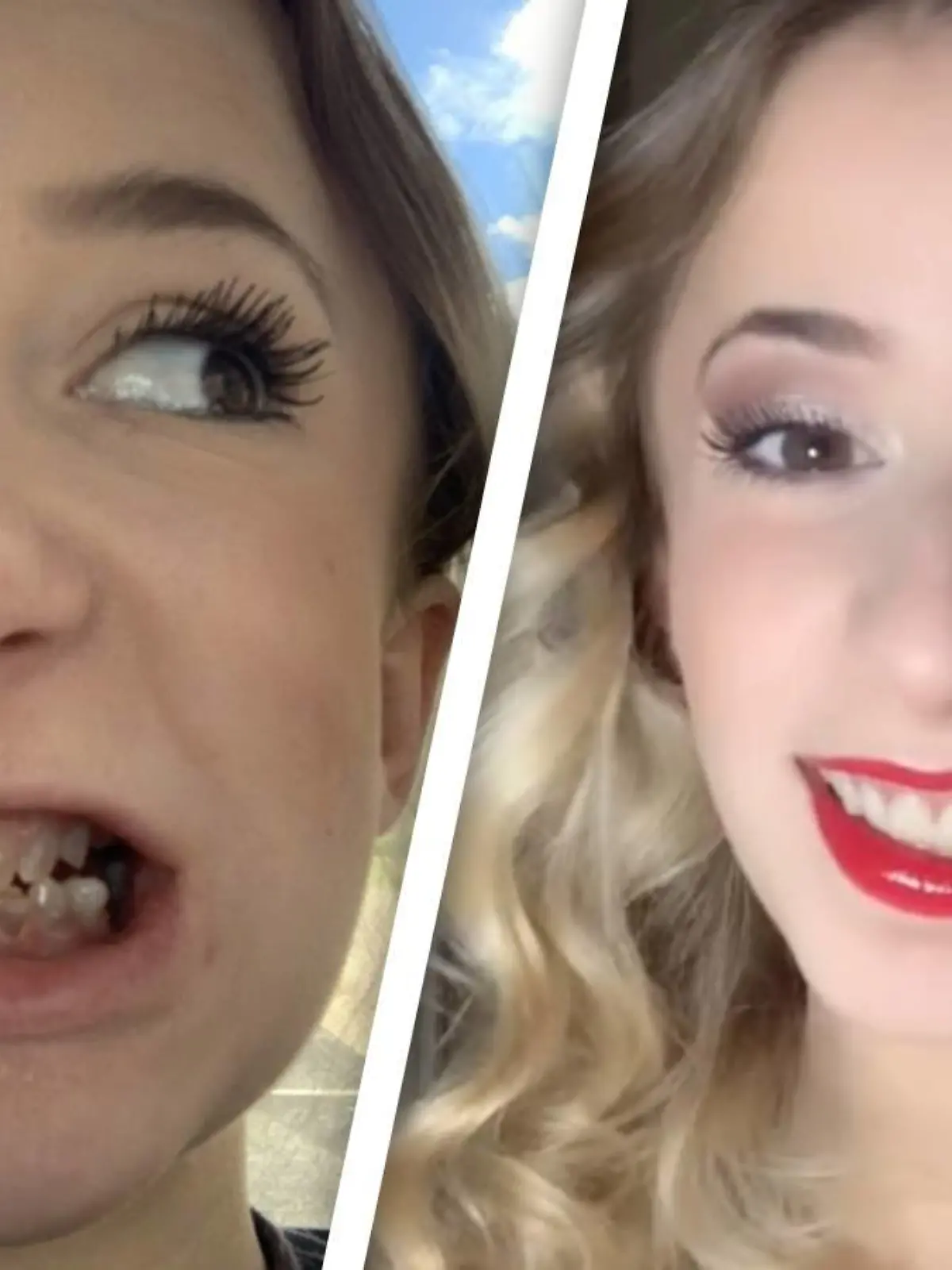 Mihaleys Zähne vor und nach der OP