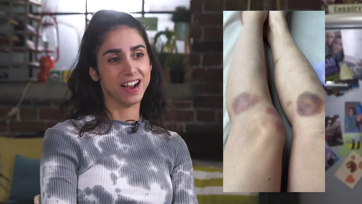 Autsch! Blaue Flecken bei AWZ-Star Suri Abbassi Wie konnte DAS passieren?