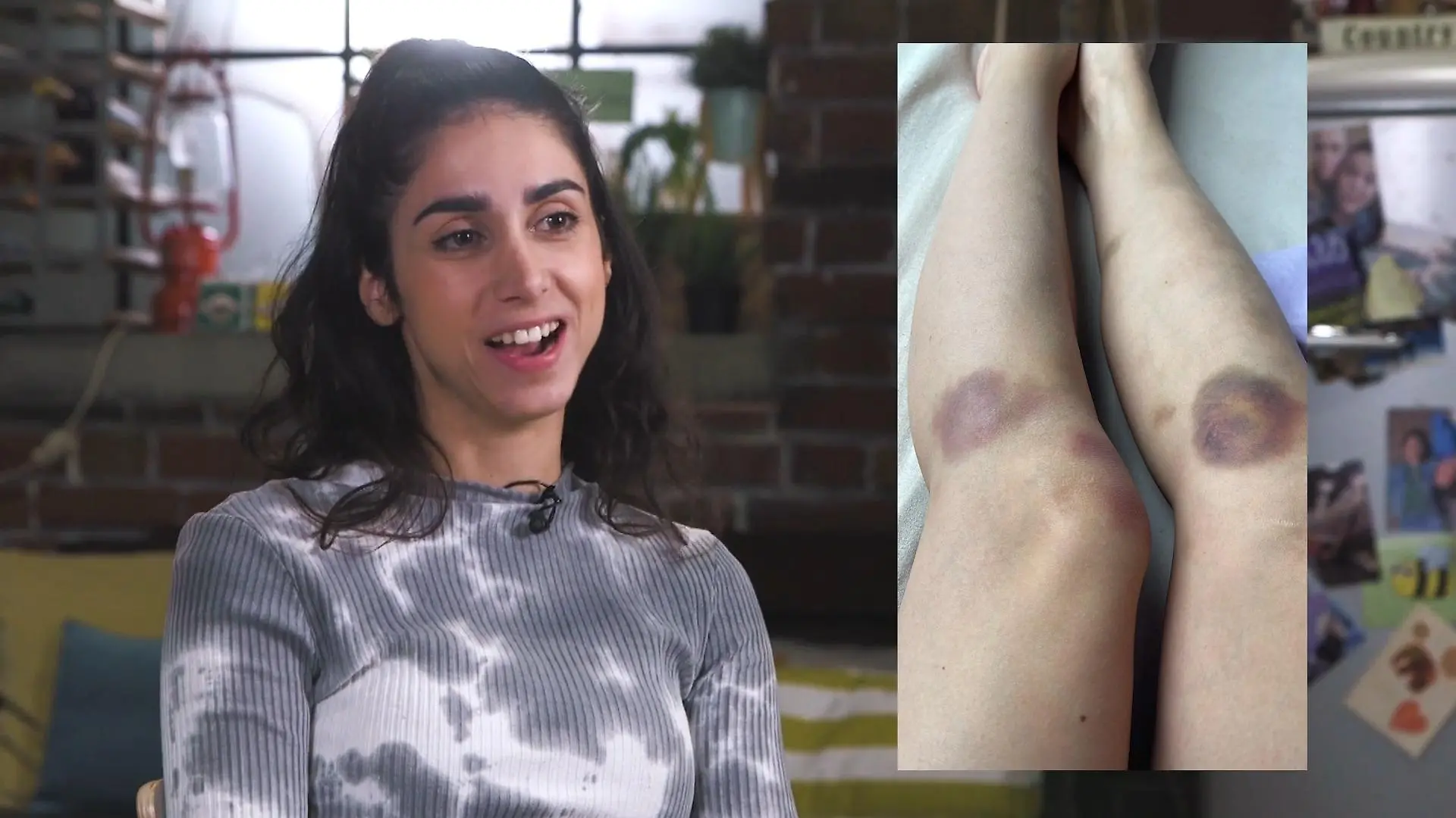 Autsch! Blaue Flecken bei AWZ-Star Suri Abbassi Wie konnte DAS passieren?