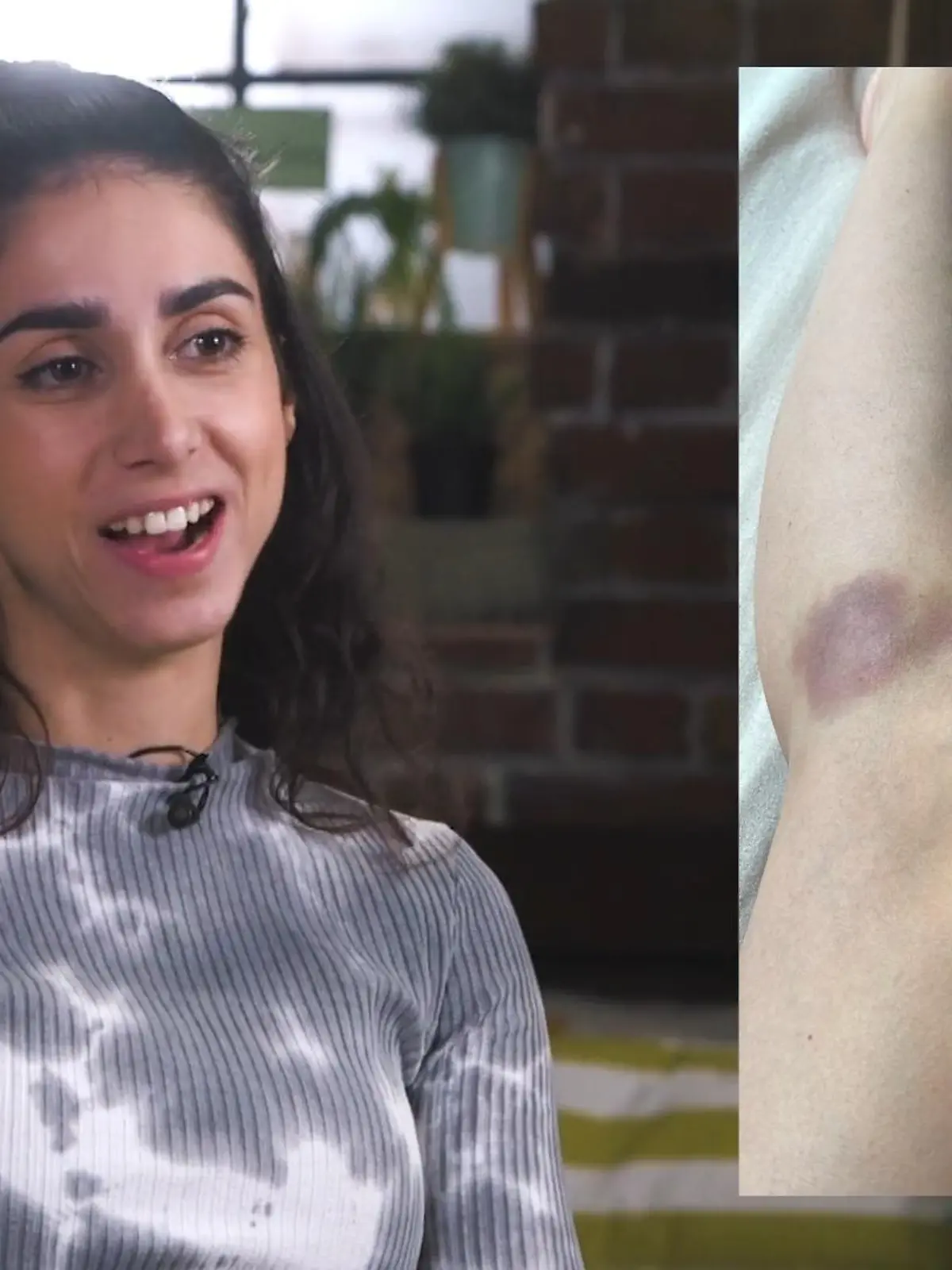 AWZ-Star Suri Abbassi: blaue Knie von den Dreharbeiten zu Leylas WM-Pleite
