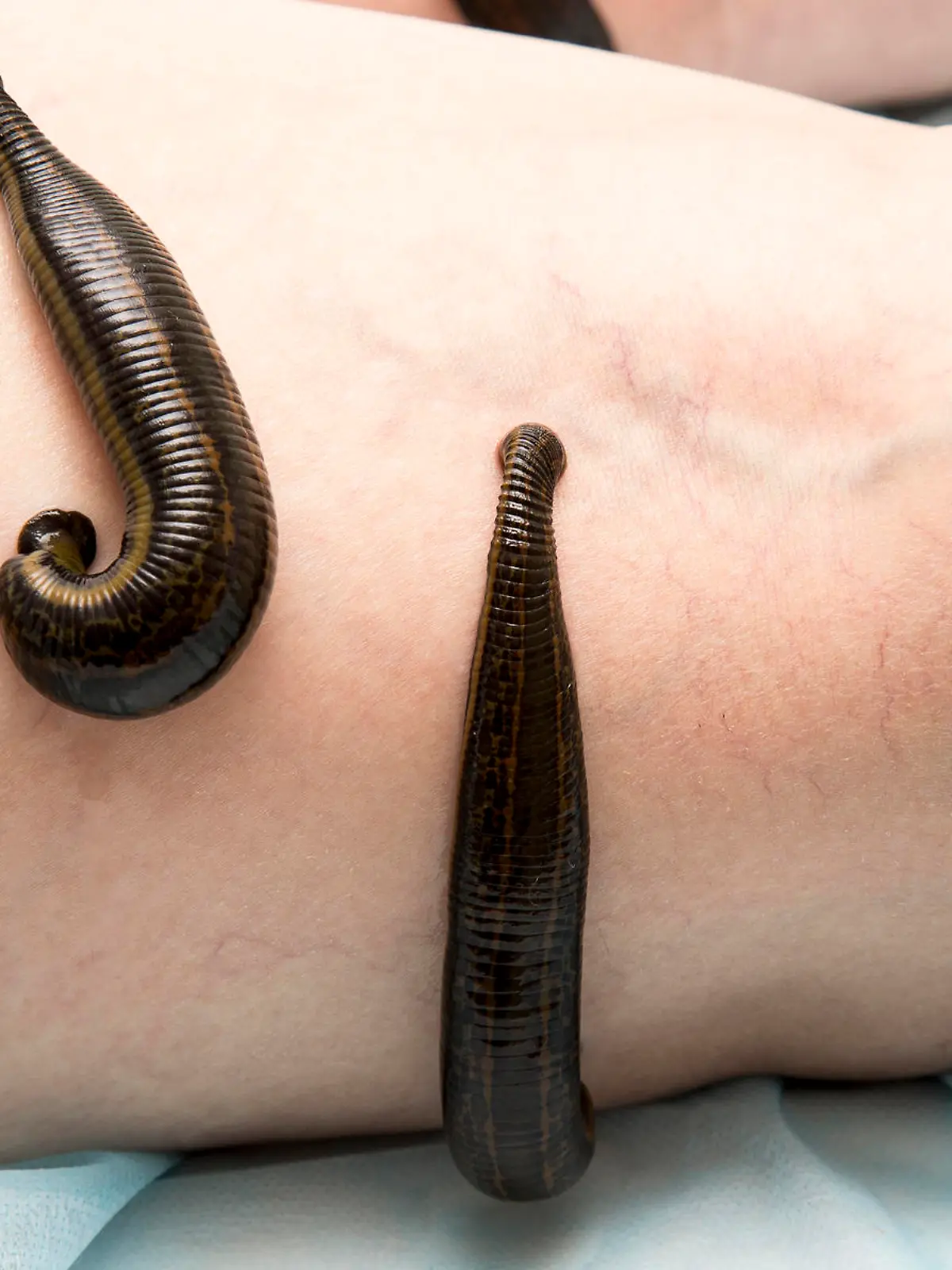 Gesundheitslexikon: Die Blutegel-Therapie stellt eine insgesamt wirksame Therapie gegen chronische Schmerzsyndrome dar.