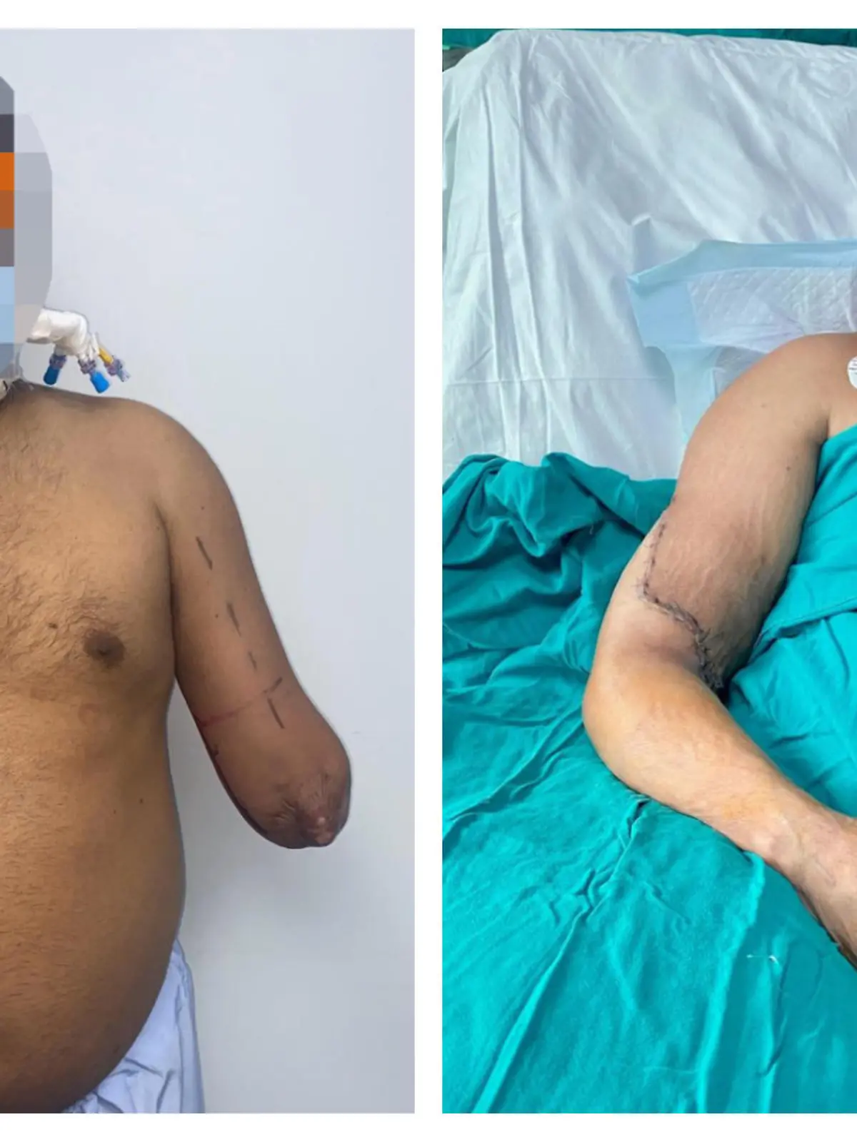 Raj Kumar vor und nach seiner Unterarm-Transplantation.