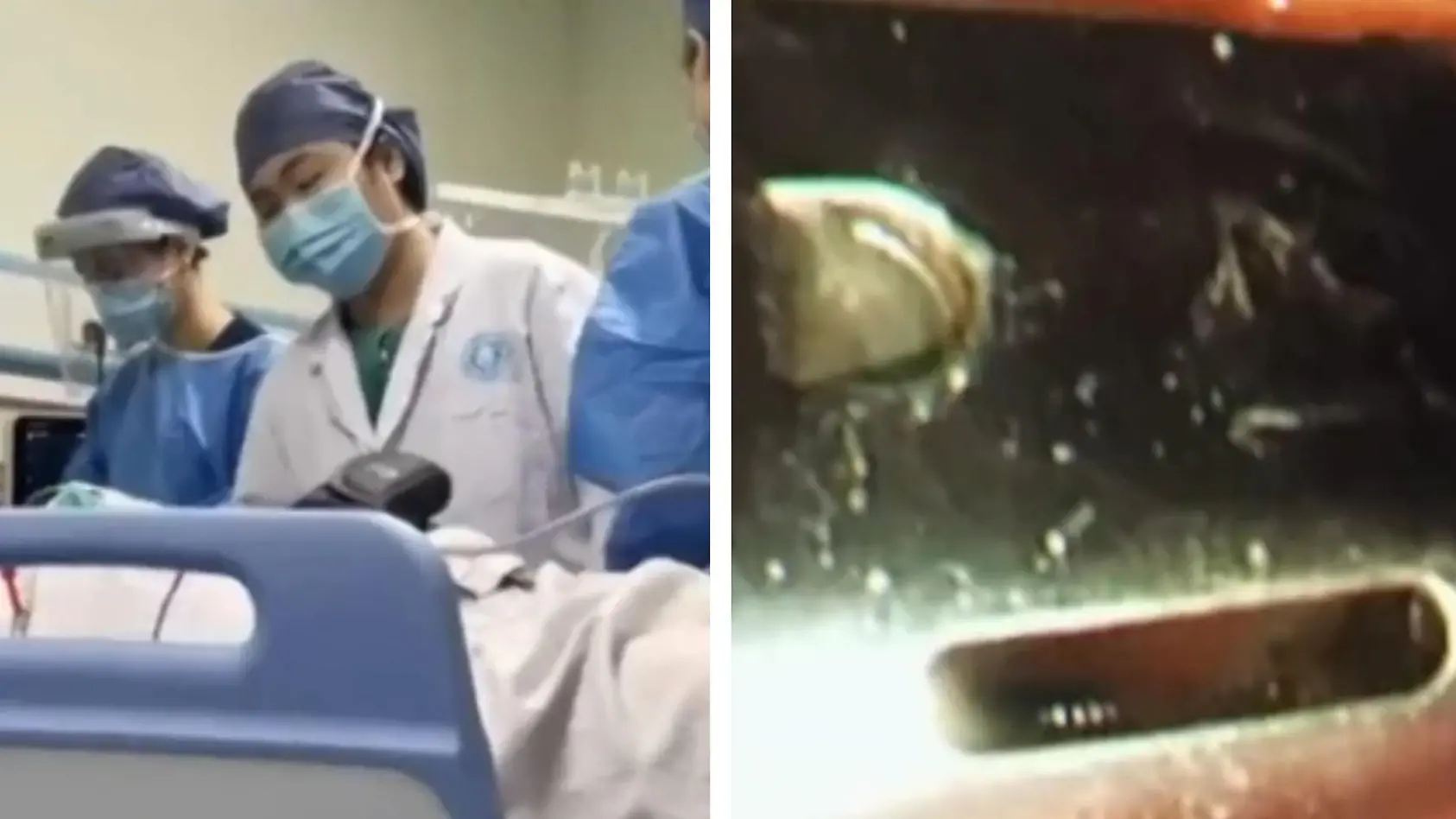 Mann verschluckt Schere und Feuerzeuge