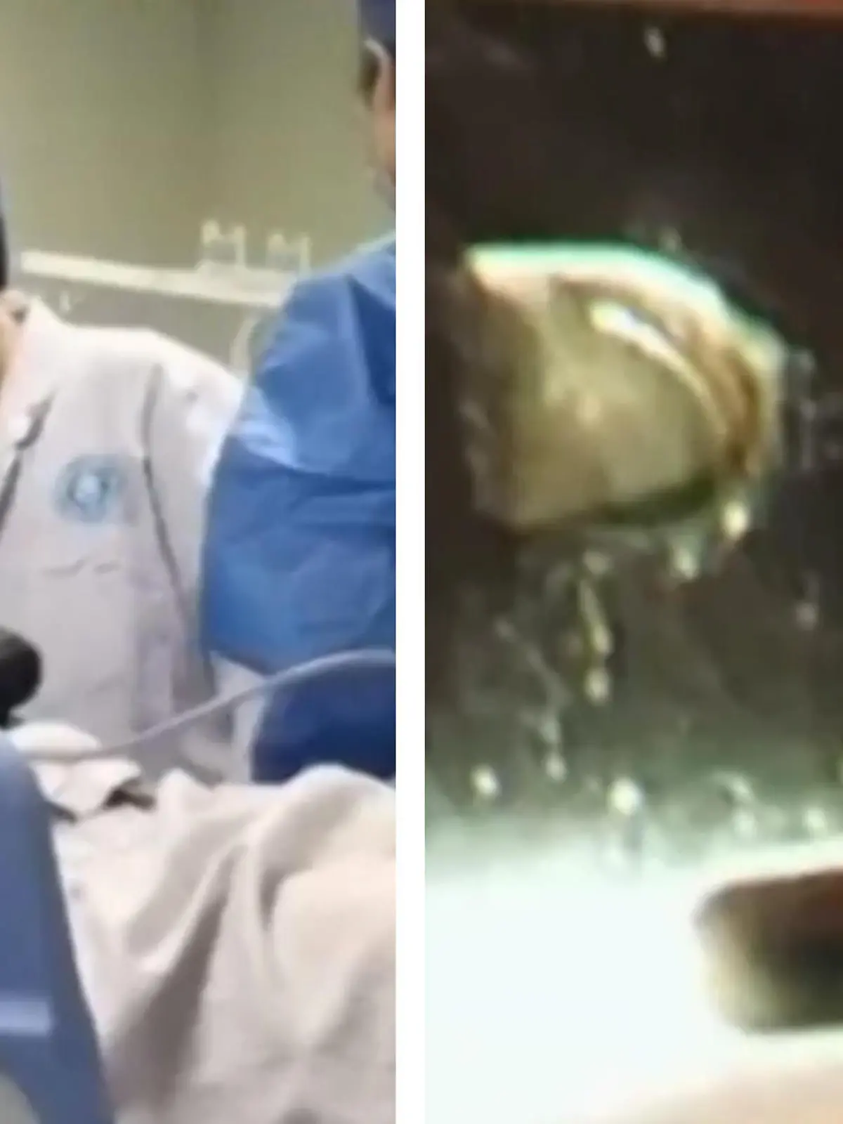 In China staunen die Ärzte nicht schlecht. Denn sie müssen einen Mann operieren, der drei Feuerzeuge und eine Metallschere verschluckt hat. Doch der Eingriff ist riskant. Ob sie dem Mann helfen können und was im schlimmsten Fall passieren kann, erfahrt ihr im Video.
