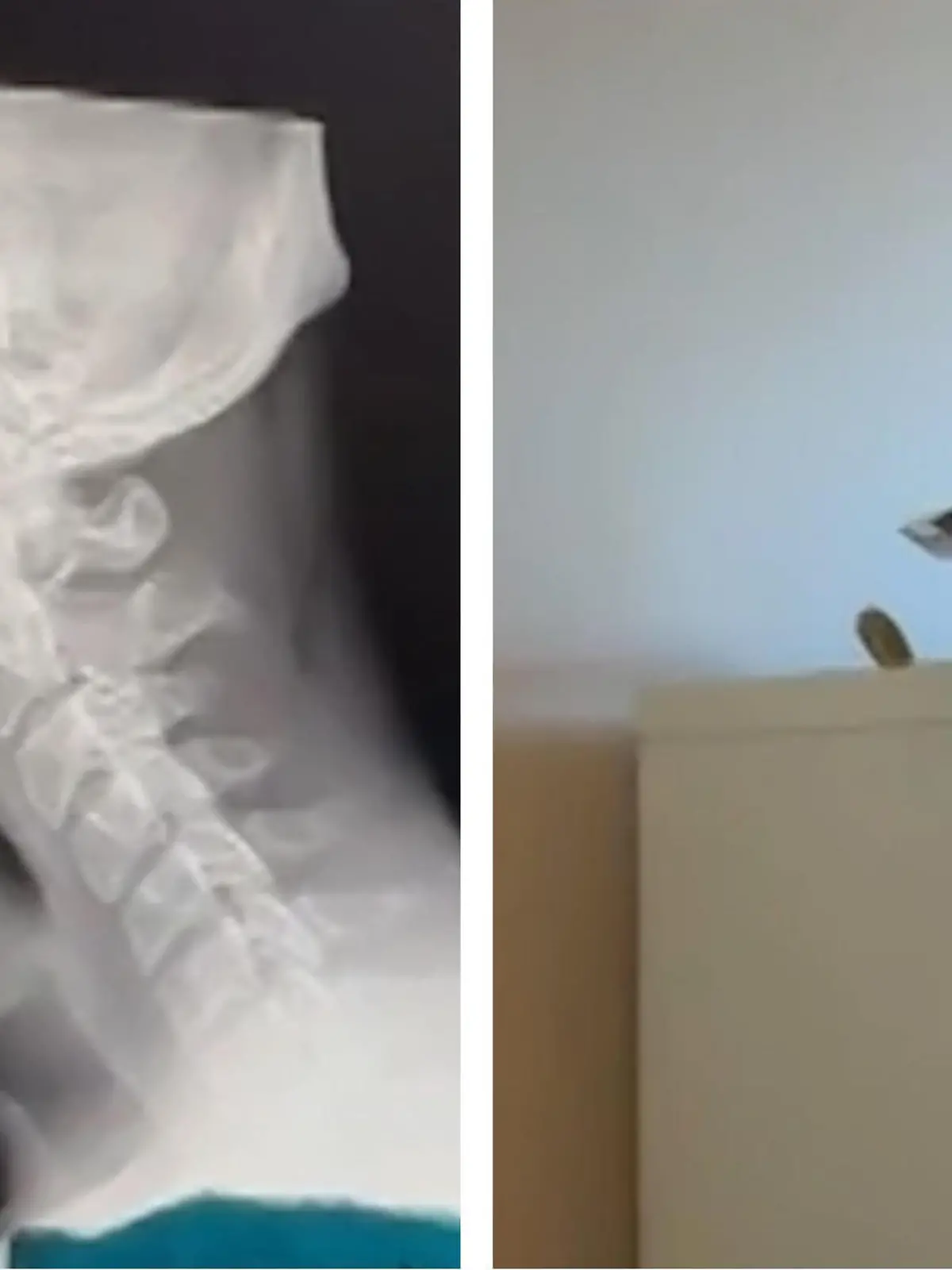 Dr. Jake Boyle will warnen – vor allem jüngere Menschen. Denn sie alle laufen Gefahr, sehr früh einen Buckel zu bekommen. Unterschiedliche Röntgenbilder des Chiropraktikers zeigen, wie sehr sich unsere Wirbelsäule im Laufe der Zeit verändert hat. Die echt krassen Bilder seht ihr im Video.