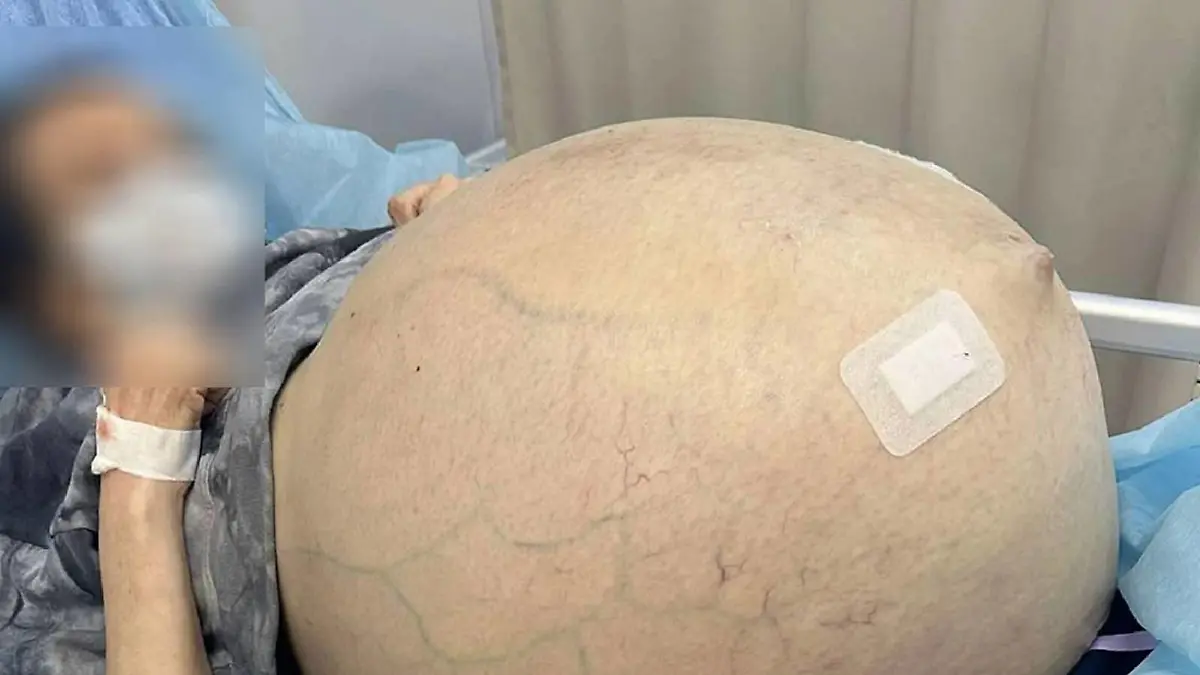 Tumor ließ Frau schwanger aussehen.