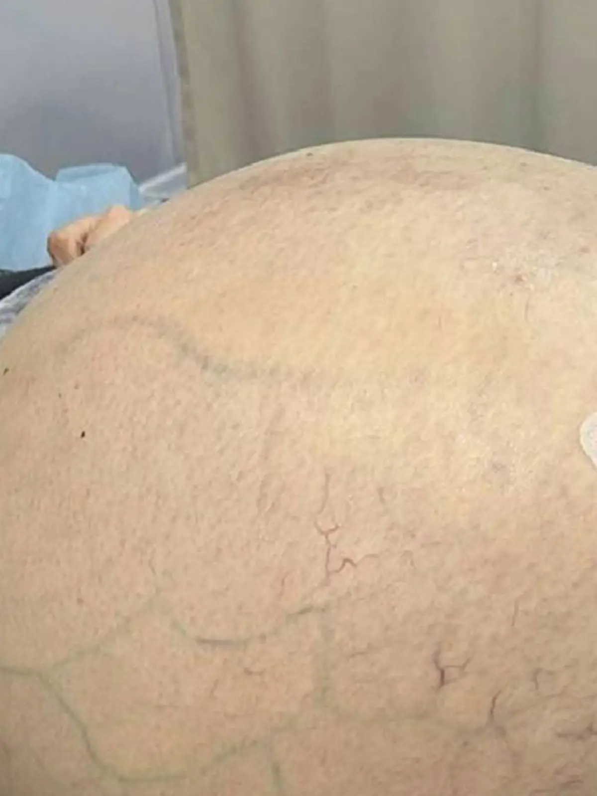 Tumor ließ Frau schwanger aussehen.