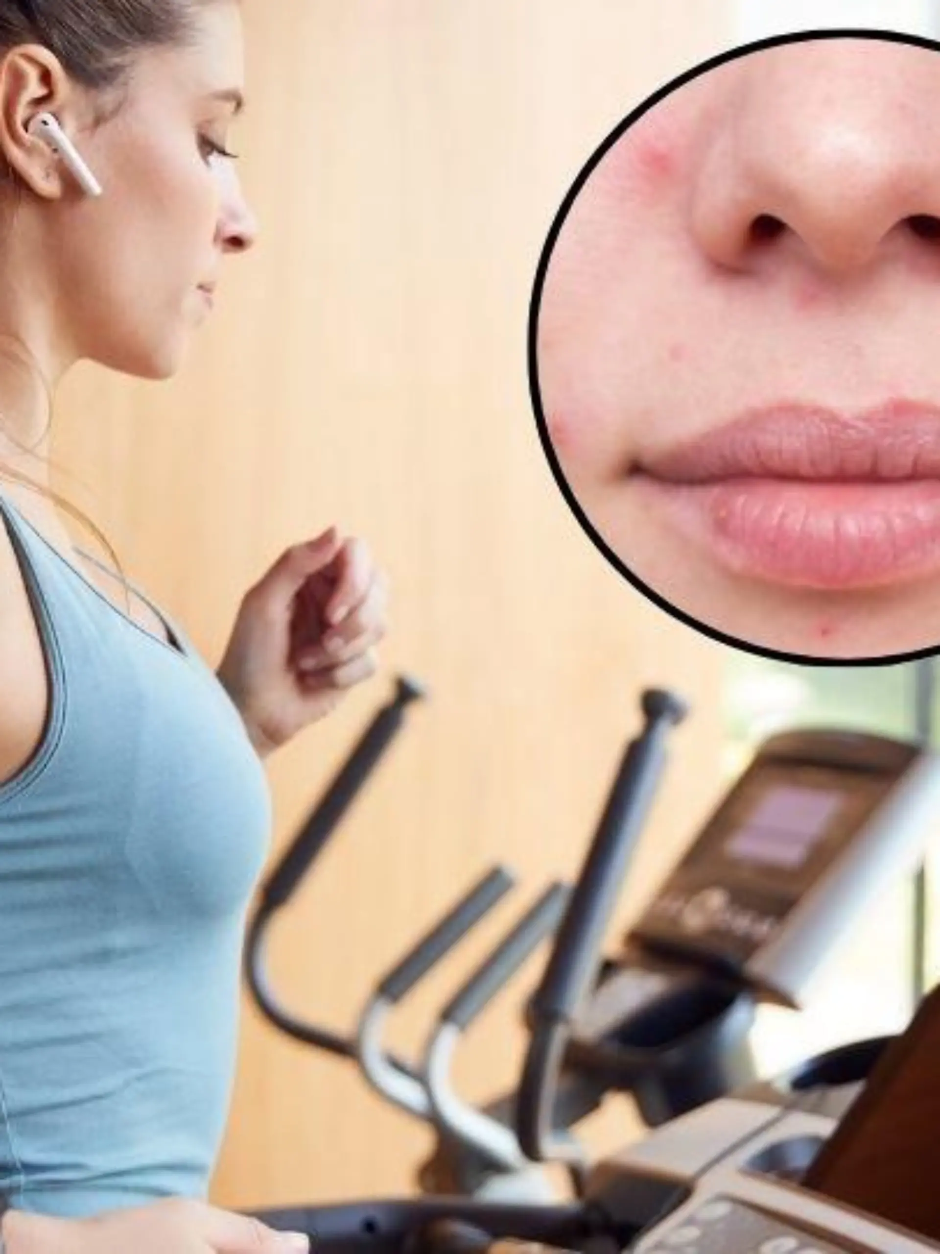 fitness laufband fitnessstudio workout Bildverwendung nur mit Urhebervermerk: Monkey Business 2/Shotshop/picture alliance. & Woman face with problematic skin