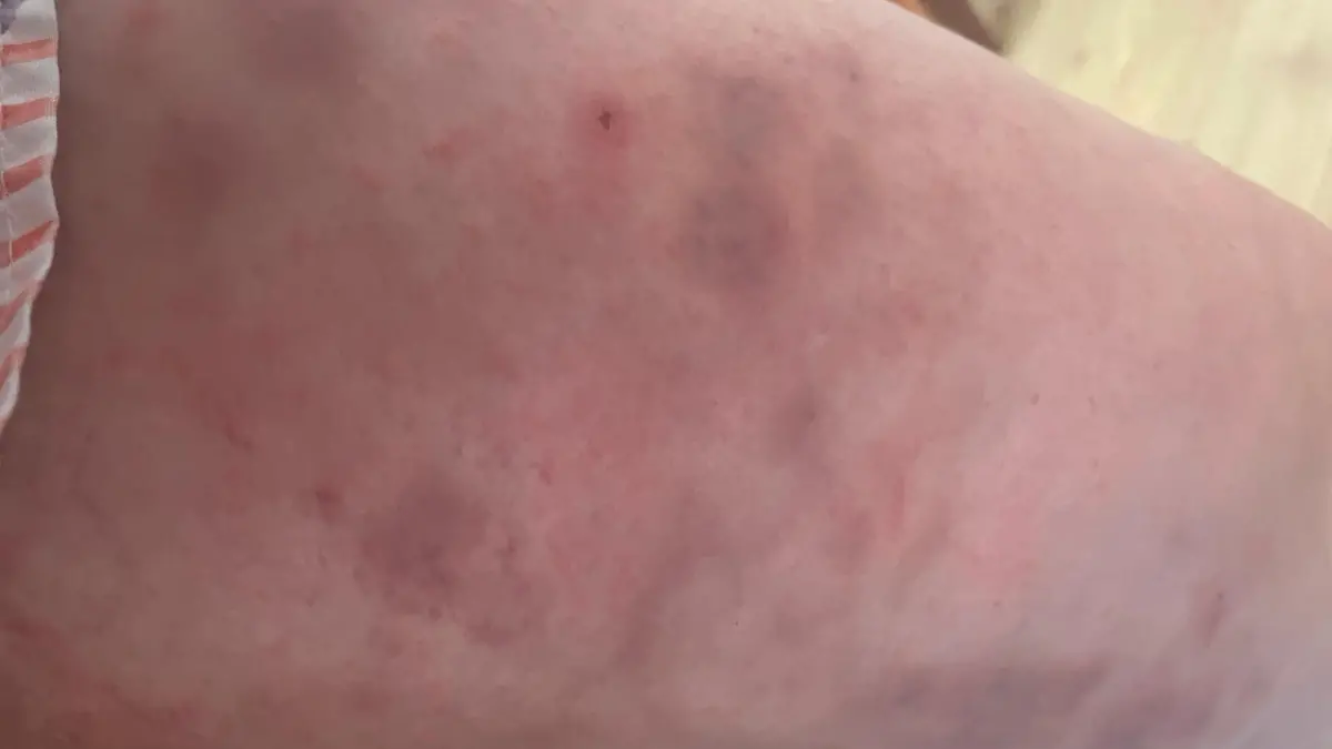 Story from Jam Press (False Widow Bite)

Pictured: Video grab - Tracy Keeble's leg 5 weeks after the initial bite.

'Doctors say they've never seen anything like it': Gloucestershire mum, 43, covered in horrific bruises after getting bit by false widow spider on dog walk

A mum bit by a false widow spider says she was covered in bruises so horrific, doctors at first thought she'd been in a car accident.

Tracy Keeble, 43, from Forest of Dean, Gloucestershire, had been walking her dog Dottie last month (22 July) when she believes she was bitten by the critter. 

The mum-of-three decided to opt for sandals rather than her normal hiking boots due to the extreme heatwave and when returning home noticed a bite on her ankle.

At first, she shrugged off it as a red ant bite and treated it with her usual insect bite cream – but over the course of the next few weeks, Tracy was shocked to find marks spreading across her arms and dark bruising on her legs.

The Product development executive made a trip to hospital where doctors ran blood tests and told her she may have been bitten by a deadly spider. 

Venom from false widow spiders are 230 times stronger than native UK species and can win battles against other spiders as well as shrews and bats.

"It's caused me so much faff, I'm just disappointed I can't climb ceilings and make my own webs like Spiderman," Tracy, who lives with husband Rob, 44, and son Will, 16, told NeedToKnow.online. 

"When I first saw the bite I just thought it was from a red ant or something and didn't think much of it, I thought it was my own fault for wearing sandals.

"But over the next week it started spreading and when the bruising happened I thought I had sepsis. 

"I thought I was going to have to loose a leg or something, I was really panicking. 

"When I turned up to the hospital, the bruising on my legs was so bad doctors kept asking me if I was a victim of trauma. I looked like I had been in a car accident. 

"I get why they asked and it's 