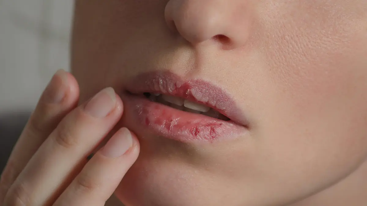 Dermatillomania skin picking. Woman has bad habit to pick her lips. Harmful addiction based on anxiety stress and dry lips. Excoriation disorder. Sick cracked damaged tissue.