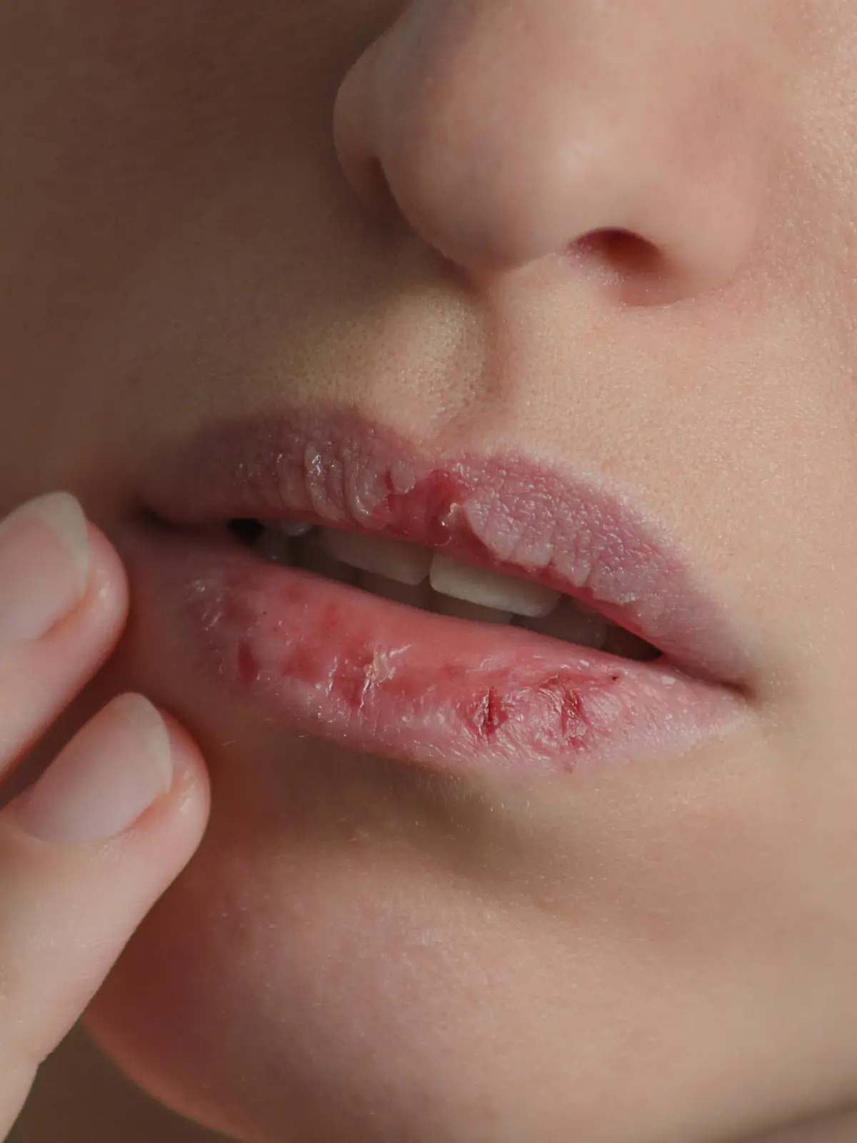 Dermatillomania skin picking. Woman has bad habit to pick her lips. Harmful addiction based on anxiety stress and dry lips. Excoriation disorder. Sick cracked damaged tissue.