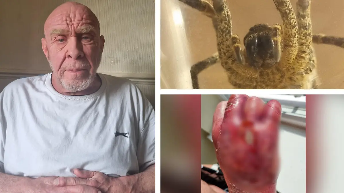 Mann verliert fast seine Hand wegen Spinnenbiss