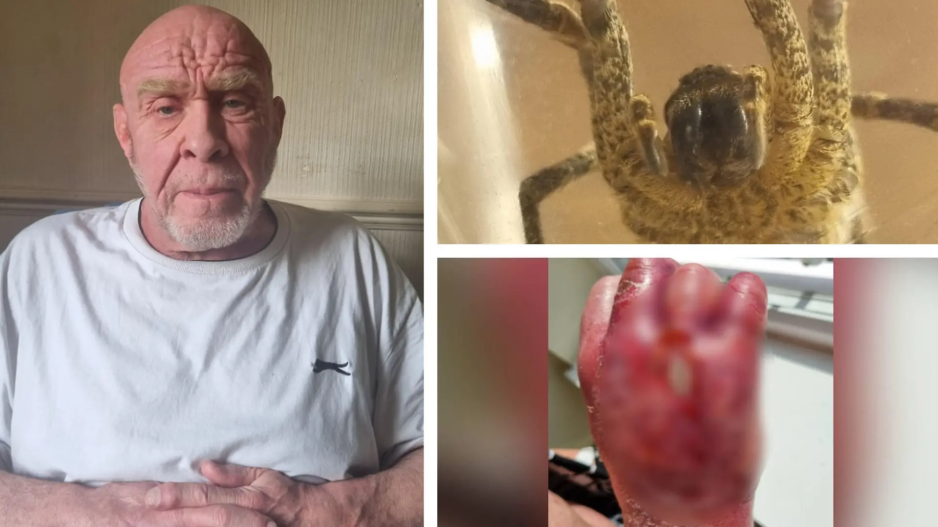 Mann verliert fast seine Hand wegen Spinnenbiss