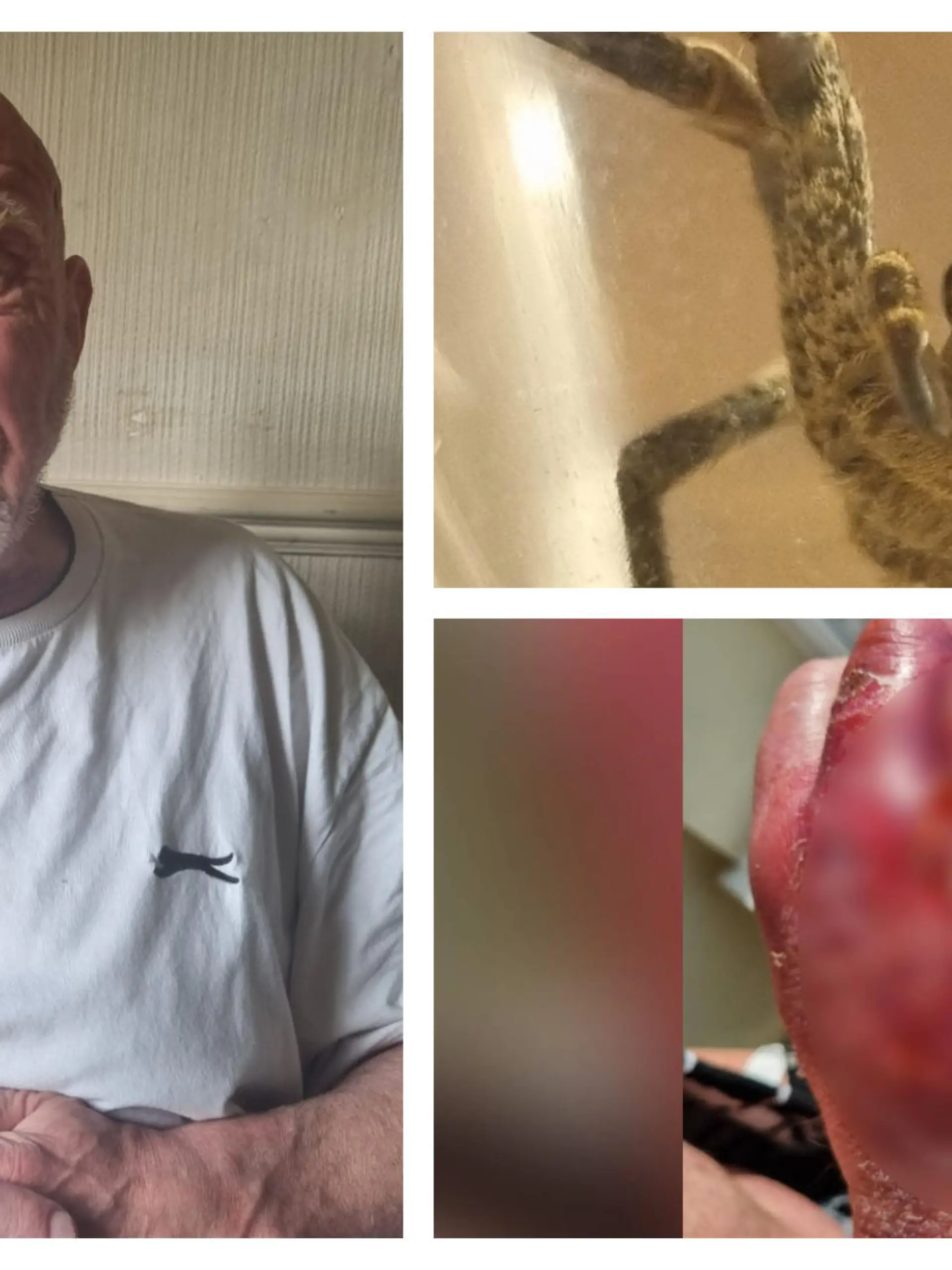 Mann verliert fast seine Hand wegen Spinnenbiss