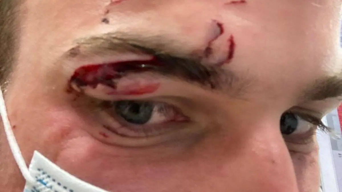 SONDERKONDITIONEN: Satzpreis!
Reece Taylor, 27, and his injury after getting bitten by a dog he saved the life of on thursday 25 august, after jumping into the River Wensum, Norwich. See SWNS story SWLNdog. An animal lover who leapt into a river to save a drowning dog ended up in hospital - when the ungrateful mutt bit him on the face. Reece Taylor, 27, leapt into action while cycling alongside a river and hearing someone shouting for help to save his drowning dog. Bentley, an Italian cane corso, had fallen off the side of a boat moored at the Norwich Yacht Station, River Wensum, early on Thursday morning (25 August). Reece stripped down to his undies and leapt into the river to save the 60kg animal - only for the distressed pet to bite him on his face.
/ action press