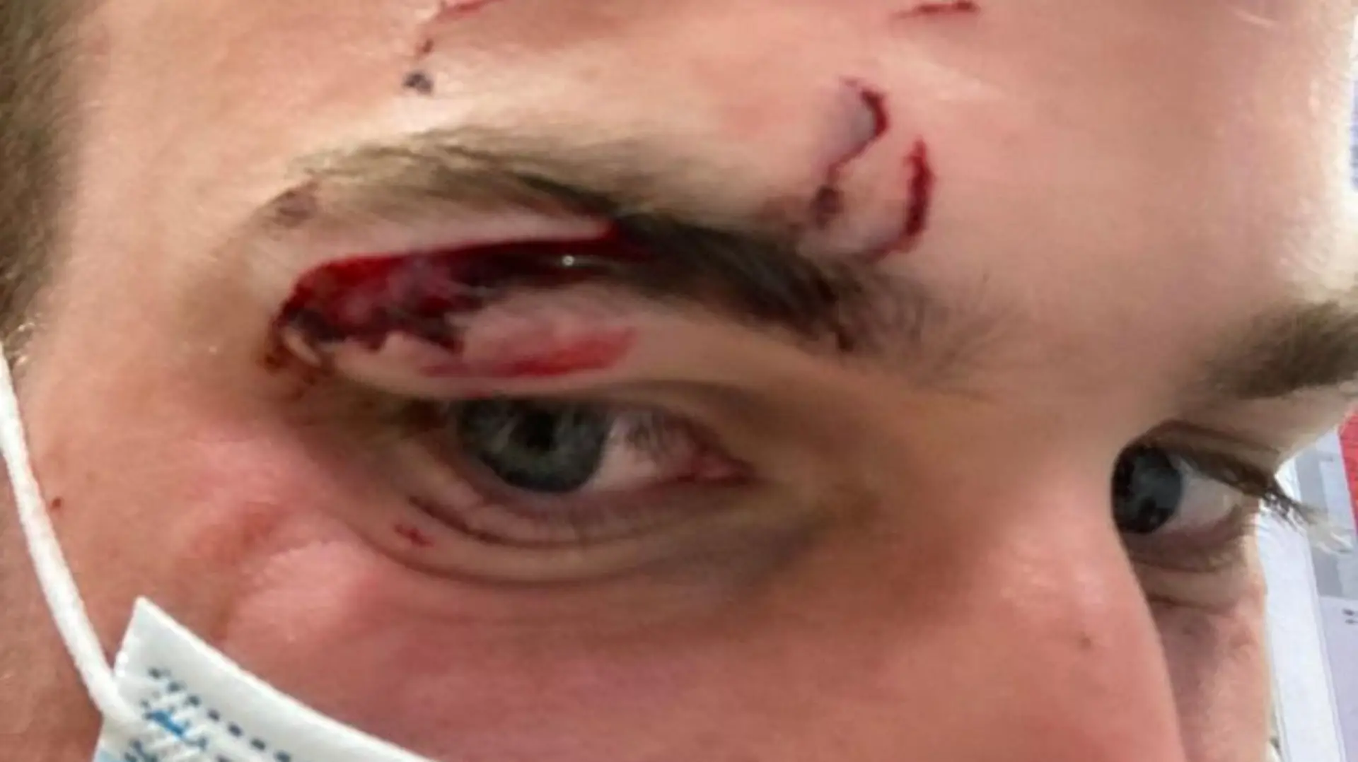 SONDERKONDITIONEN: Satzpreis!
Reece Taylor, 27, and his injury after getting bitten by a dog he saved the life of on thursday 25 august, after jumping into the River Wensum, Norwich. See SWNS story SWLNdog. An animal lover who leapt into a river to save a drowning dog ended up in hospital - when the ungrateful mutt bit him on the face. Reece Taylor, 27, leapt into action while cycling alongside a river and hearing someone shouting for help to save his drowning dog. Bentley, an Italian cane corso, had fallen off the side of a boat moored at the Norwich Yacht Station, River Wensum, early on Thursday morning (25 August). Reece stripped down to his undies and leapt into the river to save the 60kg animal - only for the distressed pet to bite him on his face. 
 / action press