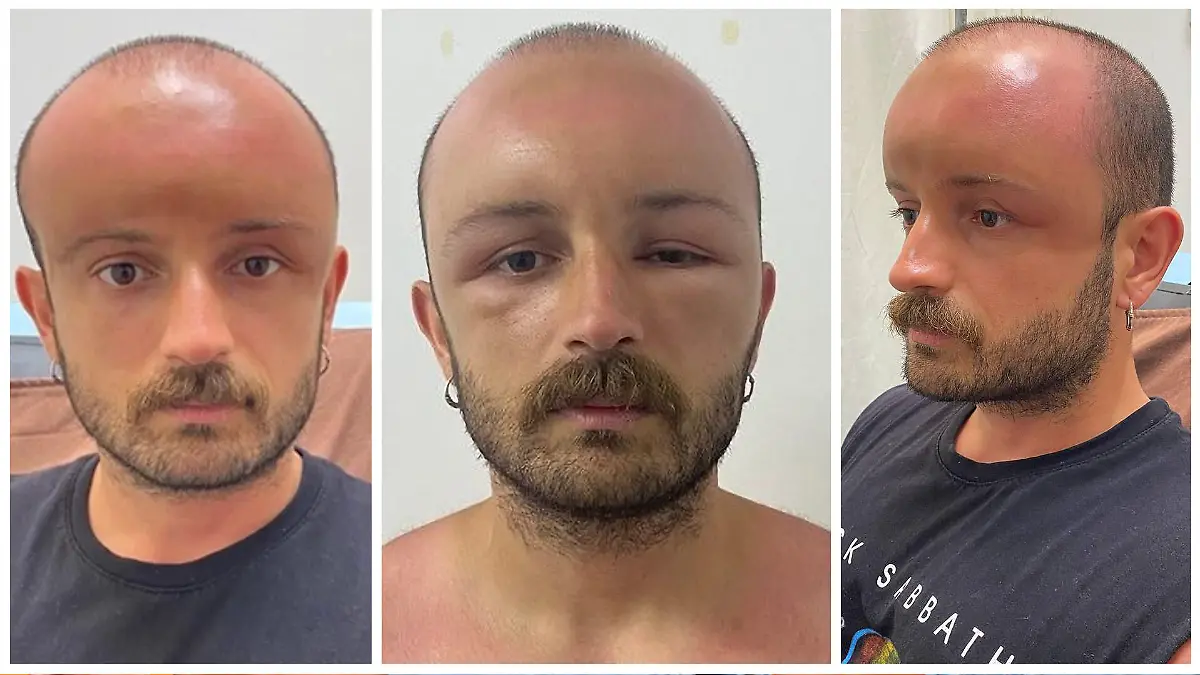 Drei Oberkörperfotos, eines davon von dem Profil, eines türkischen Mannes, dessen Kopf nach dem Sonnenbaden überdimensional groß angeschwollen ist.