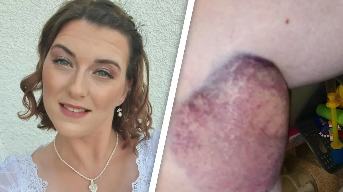 Stephanie Harveys Haut ist geschwollen und lila