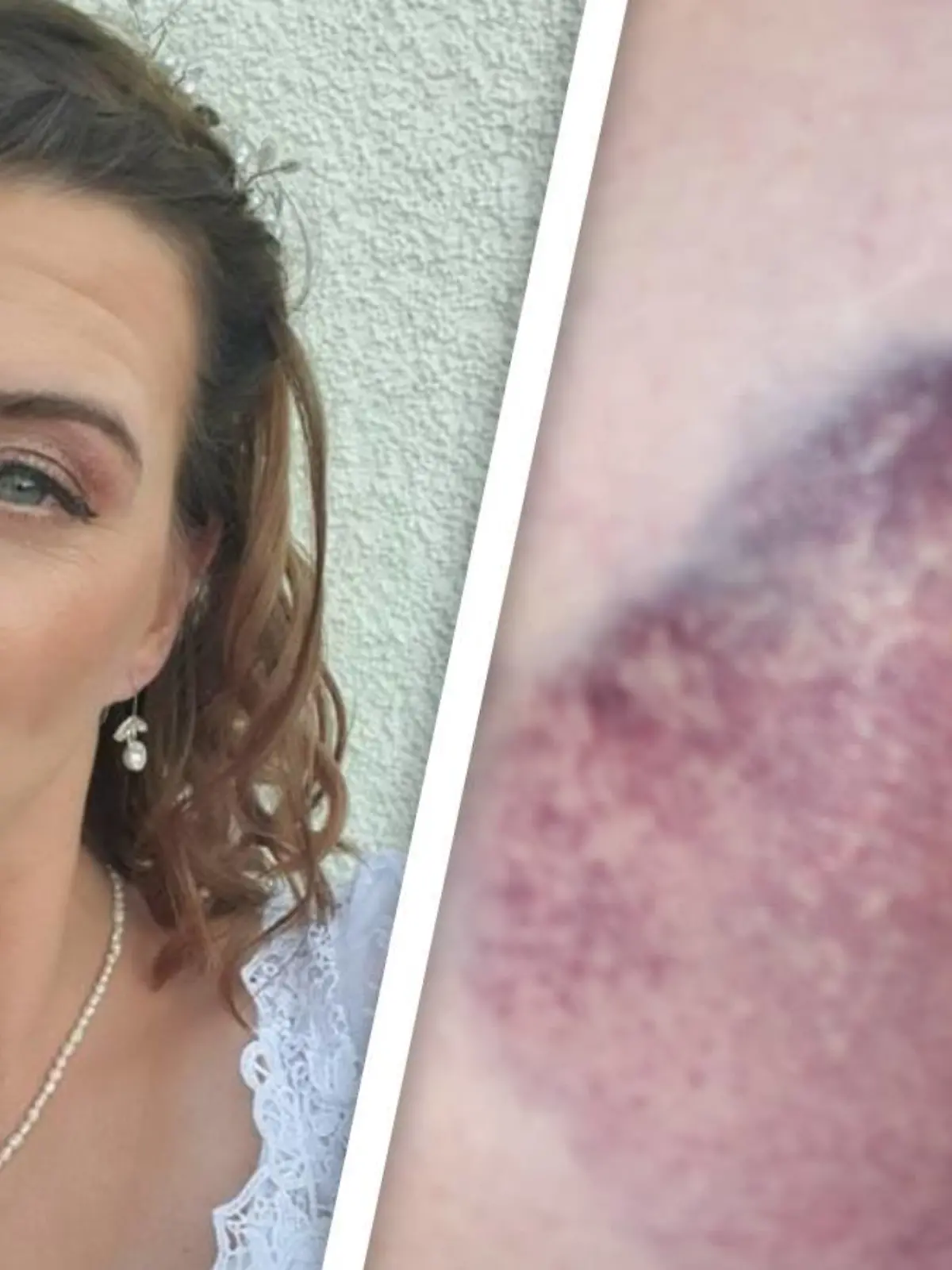 Stephanie Harveys Haut ist geschwollen und lila