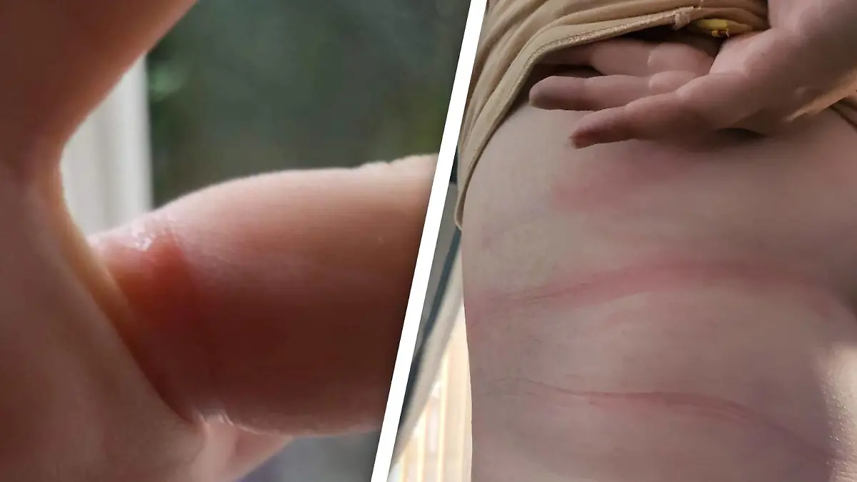 Stephanie Harvey hat Blasen am Finger, wegen des Eherings und Quaddeln am Körper nach dem BH-Tragen