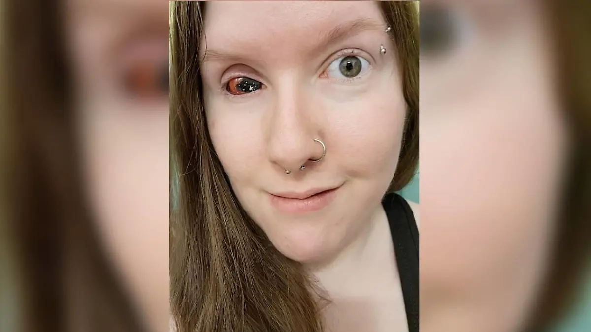Michelle Timms aus dem kanadischen Ontario hat mittlerweile eine Augen-Prothese