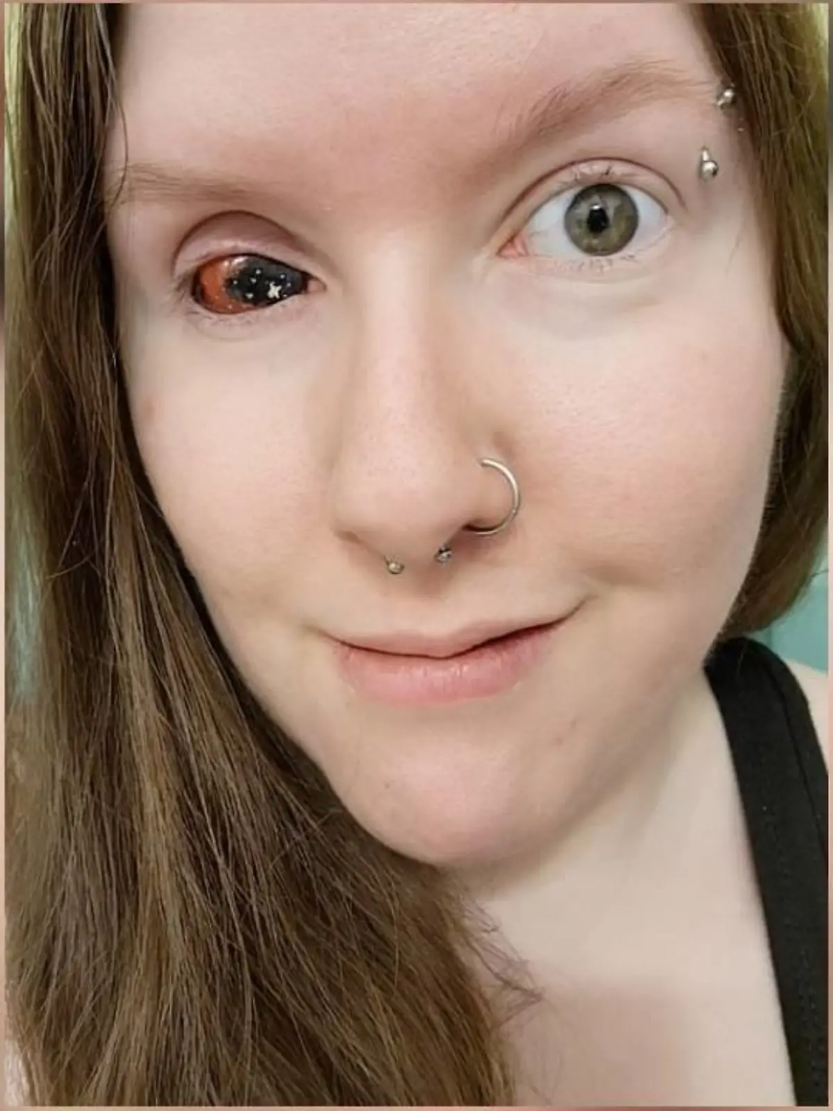 Michelle Timms aus dem kanadischen Ontario hat mittlerweile eine Augen-Prothese