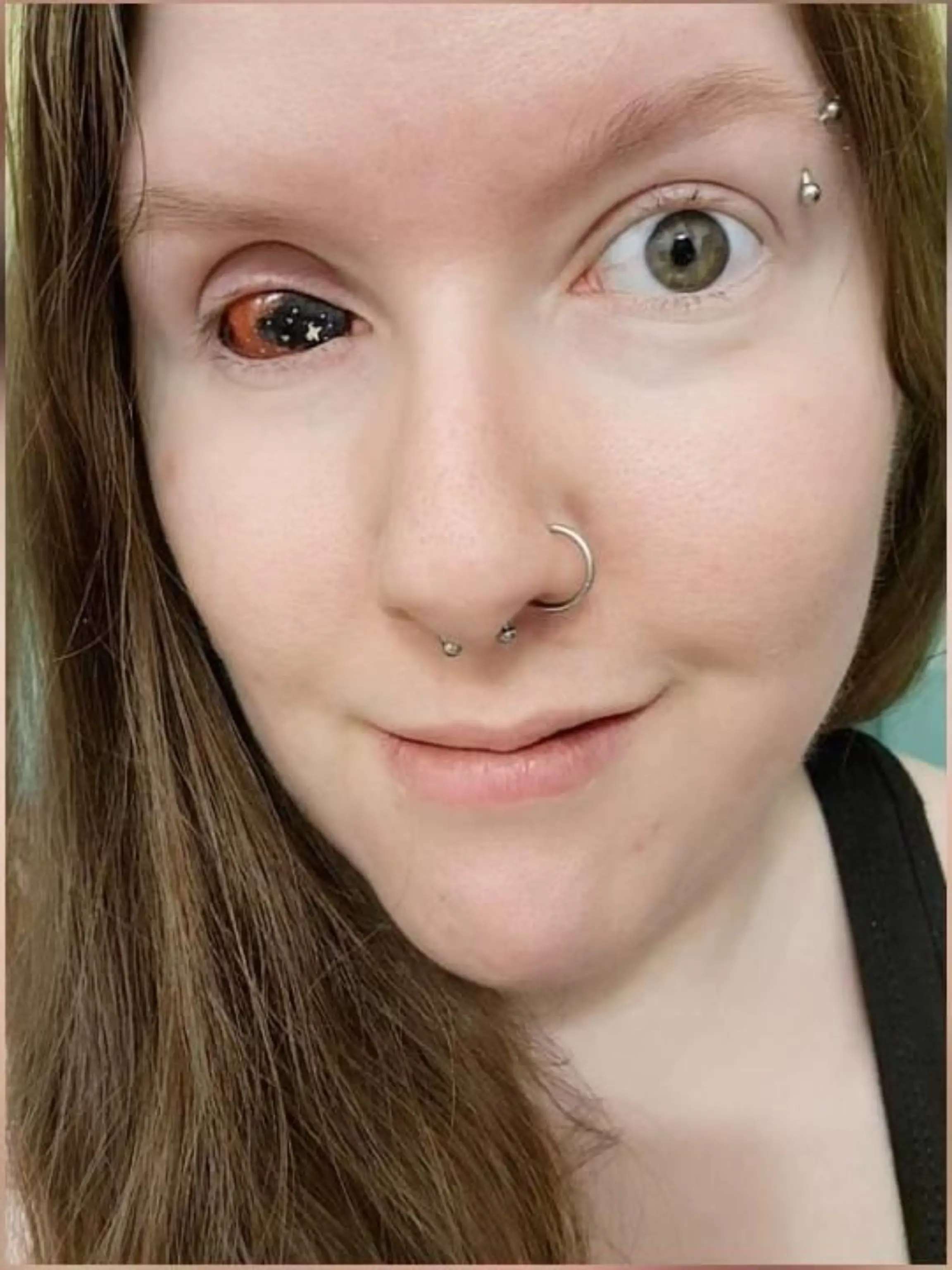 Michelle Timms aus dem kanadischen Ontario hat mittlerweile eine Augen-Prothese