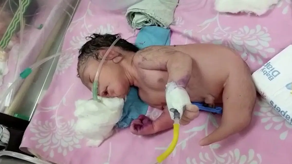 SONDERKONDITIONEN: Satzpreis!
A baby is being cared for in India after being born with a horn like structure instead of legs. See SWNS story SWFSbaby. The baby was born in Manpura Primary Health Center, in central India's Shivpuri district, and remains in a stable condition. Doctors of the Primary Health Center immediately referred the baby and the mother to the Shivpuri District Hospital. The newborn has since been kept under the supervision of special doctors in the Special Newborn Care Unit (SNCU) of the hospital. / action press