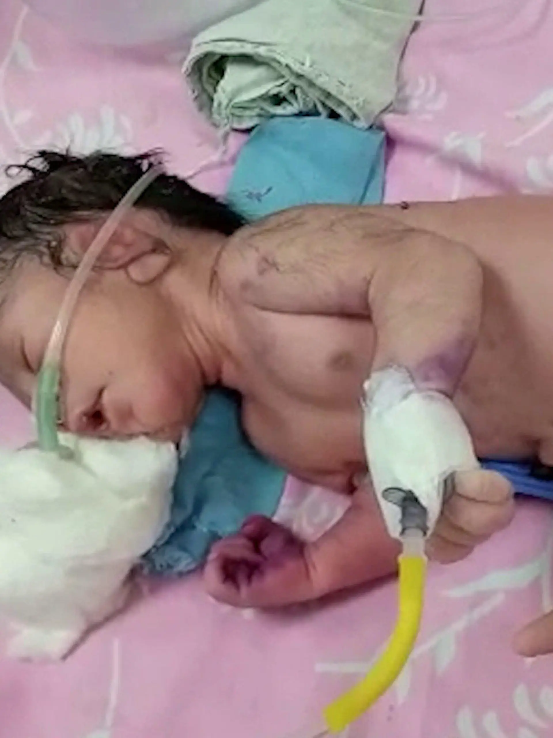 SONDERKONDITIONEN: Satzpreis!
A baby is being cared for in India after being born with a horn like structure instead of legs. See SWNS story SWFSbaby. The baby was born in Manpura Primary Health Center, in central India's Shivpuri district, and remains in a stable condition. Doctors of the Primary Health Center immediately referred the baby and the mother to the Shivpuri District Hospital. The newborn has since been kept under the supervision of special doctors in the Special Newborn Care Unit (SNCU) of the hospital. / action press