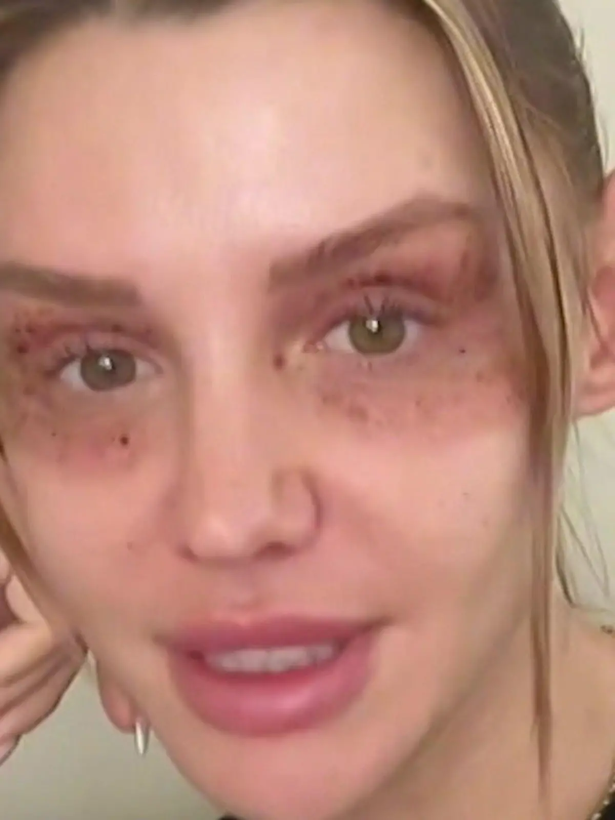 Autsch, das sieht aber schmerzhaft aus. Ex-Bachelorette Gerda Lewis überrascht in ihrer Insta-Story mit einem ungewöhnlichen Bild: Der Bereich rund um ihre Augen ist gerötet. Deswegen muss die Influencerin sogar ihren Besuch auf der Fibo absagen. Aber was ist nur passiert?