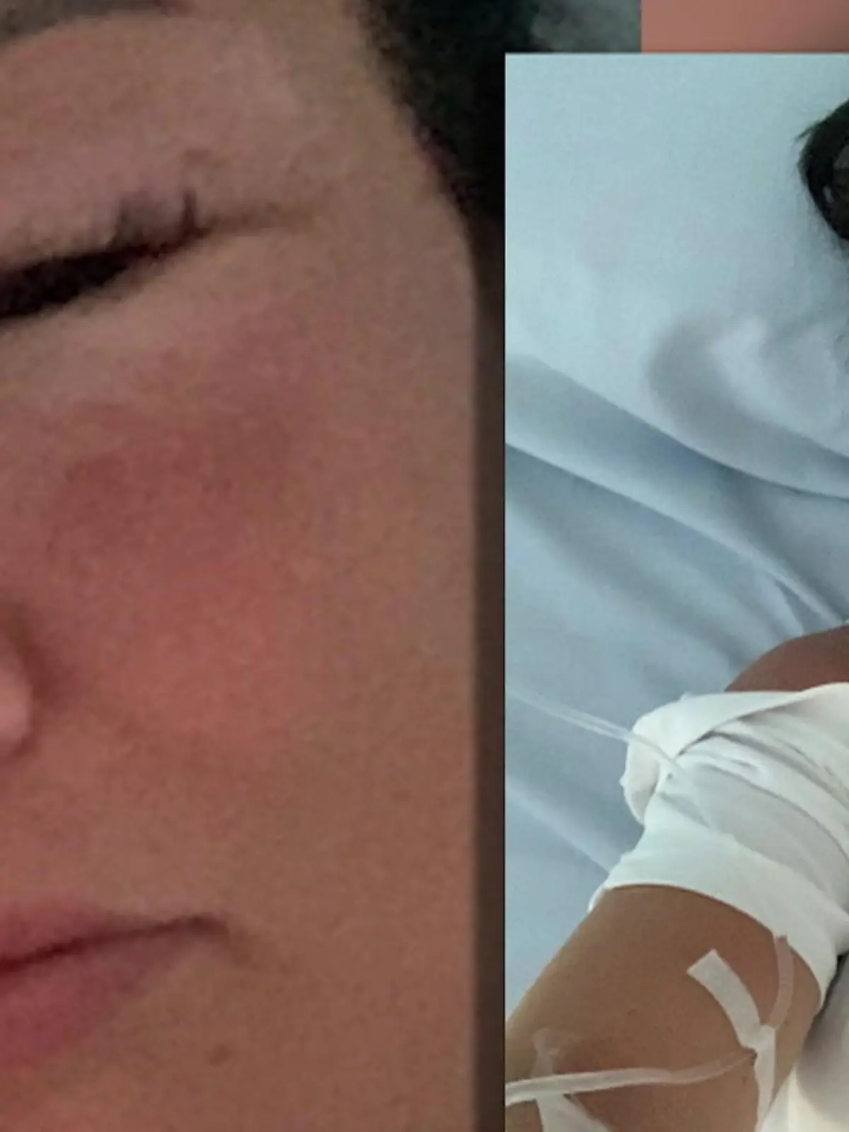 Edith Eagle ist sich sicher, dass sie der Gebrauch eines von vielen Influencern beworbenen Nasensprays, durch das man einen bräuneren Teint kriegen soll, fast das Leben gekostet hat. Versprochen wird eigentlich, dass ein paar Sprühstöße in die Nase ausreichen sollen, um „wie von der Sonne geküsst“ auszusehen. Edith Eagle aus dem britischen Norfolk wollte das auch ausprobieren. Doch die gebürtige Deutsche hat einen allergischen Schock erlitten. WIr haben mit einem Dermatologen gesprochen, der uns erklärt, was das sogenannte Melanotan so gefährlich macht.
