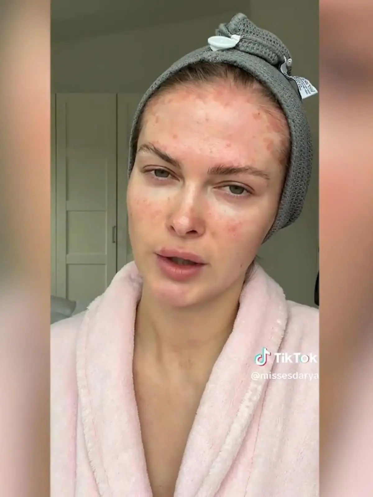 Ex-GNTM-Model Darya will ihre schlimme Schuppenflechte nicht länger verbergen