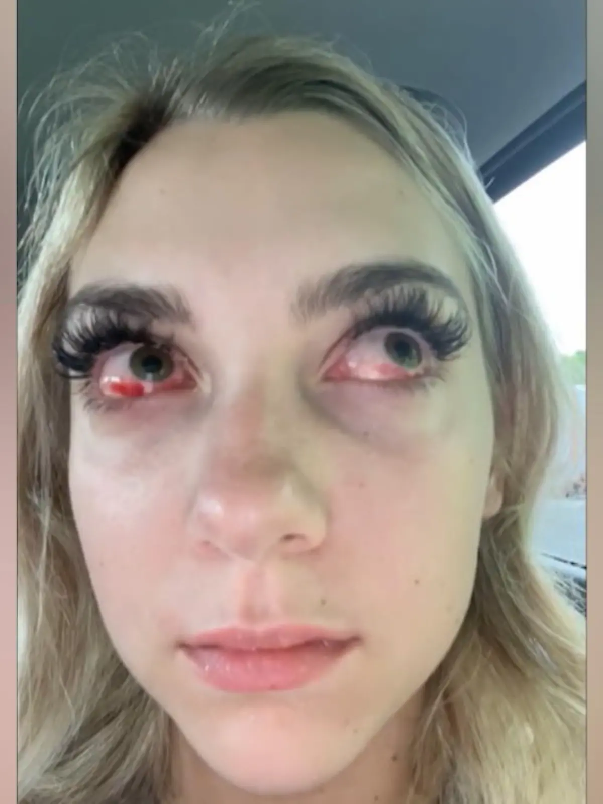 SO sehen eigentlich nur Zombies aus  - oder junge Mädchen, die eine allergische Reaktion auf eine Wimpernverlängerung entwickelt haben.