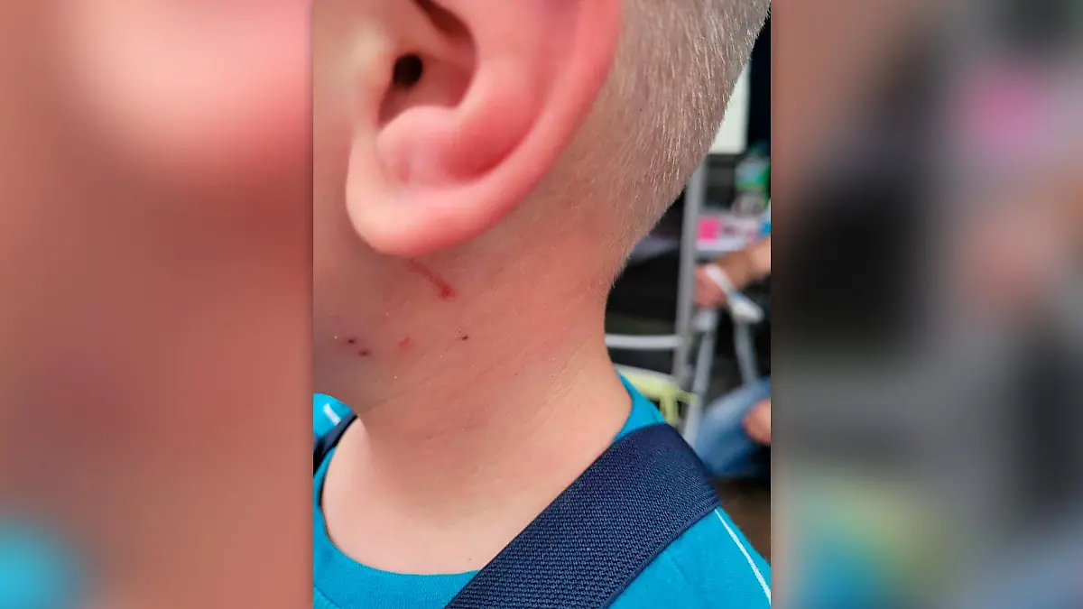 Fabian wird von einem Hund angegriffen und überlebt - dank Fahrradhelm.
