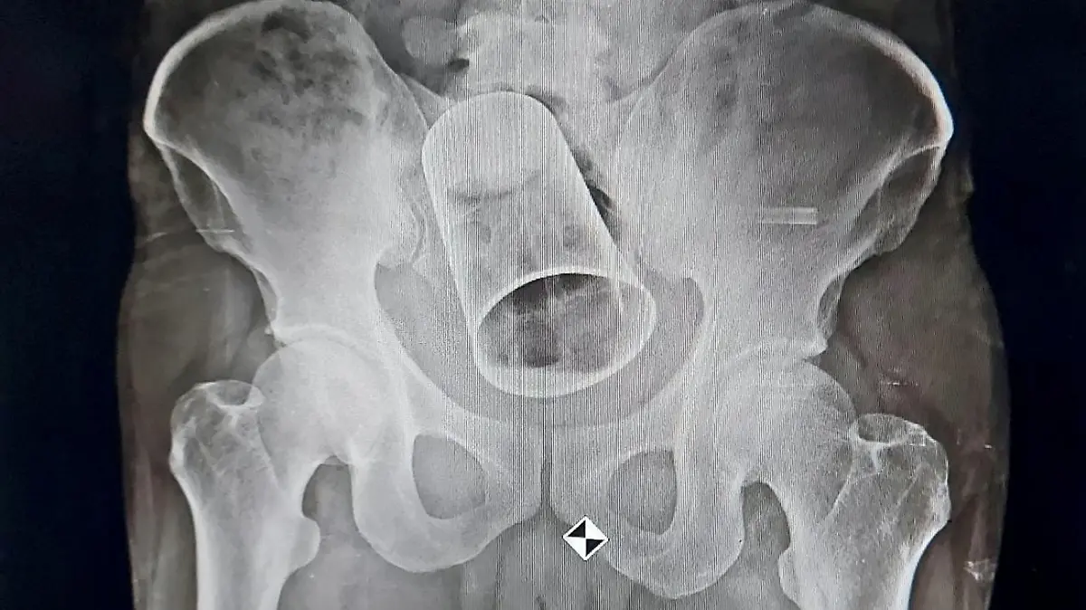 SONDERKONDITIONEN: Satzpreis!
Doctors have removed a steel cup from a man's bottom - after his friends put it up there as a drunken prank. See SWNS story SWFSsteel. The 45-year-old from Balipadar, India, had the substantially sized tumbler removed via surgery at a local hospital. The incident, which took place 19 August, happened when the unfortunate man was out drinking with his friends in Surat, Gujarat. According to reports, the victim's 'friends' inserted the sizeable item up his anus whilst he was in an ''inebriated state''. An X-Ray was done at MKCG Medical College and Hospital at Berhampur city, and the glass was found stuck in the intestine. At first, the doctors tried to retrieve the glass through rectum but then resorted to surgery due to the sheer size of the glass. Doctors had to cut through the intestine to retrieve the object. The unlucky man is recovering after the surgery and his condition is said to be stable.  / action press